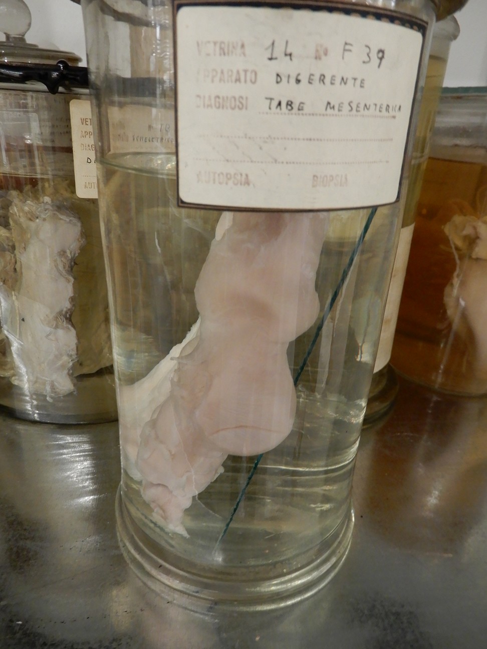 singolo reperto antropologico, preparato anatomico (morfologia alterata per patologia) (XIX-XX)