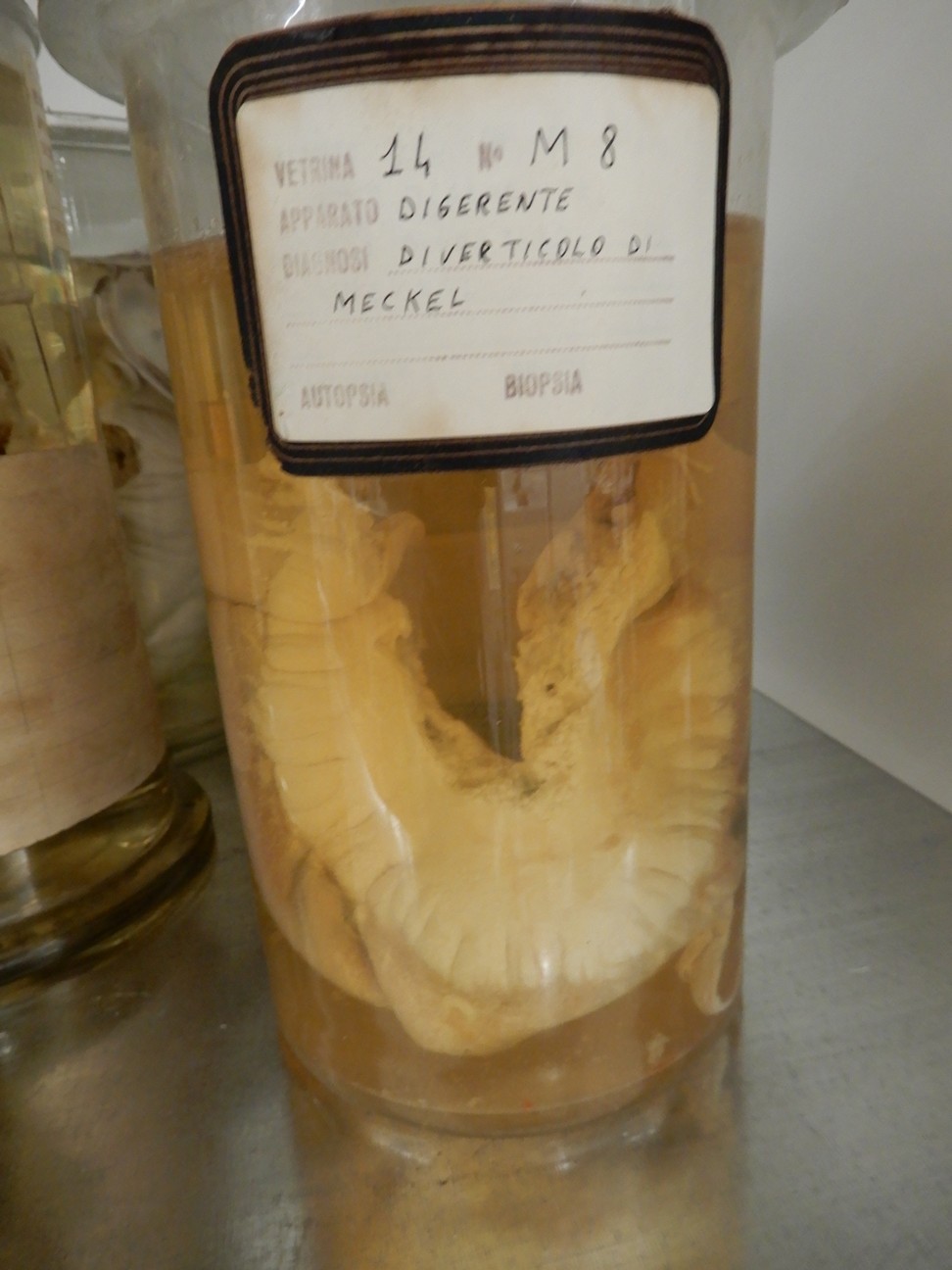 singolo reperto antropologico, preparato anatomico (morfologia alterata per patologia) (XIX-XX)