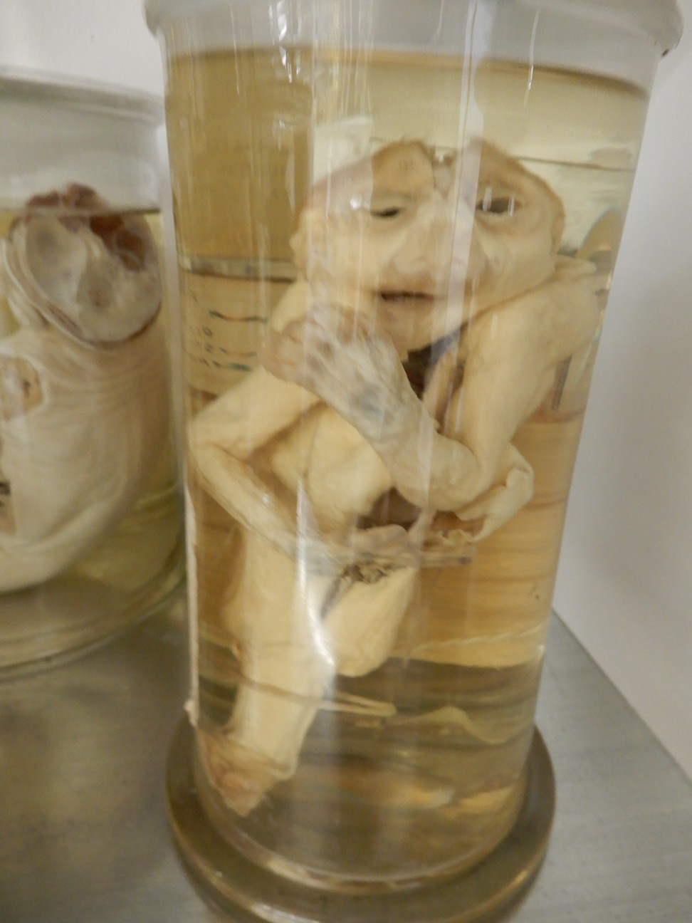 singolo reperto antropologico, preparato anatomico (morfologia alterata per patologia) (XIX-XX)