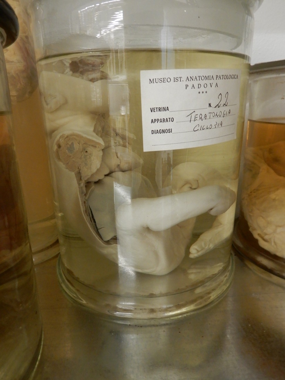 singolo reperto antropologico, preparato anatomico (morfologia alterata per patologia) (XIX-XX)