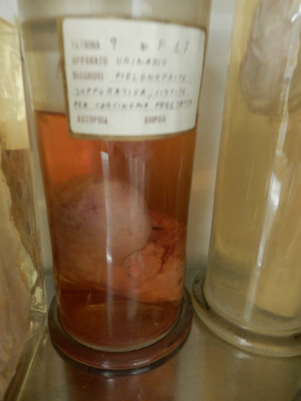 singolo reperto antropologico, reperto osseo (morfologia alterata per patologia) (XIX-XX)