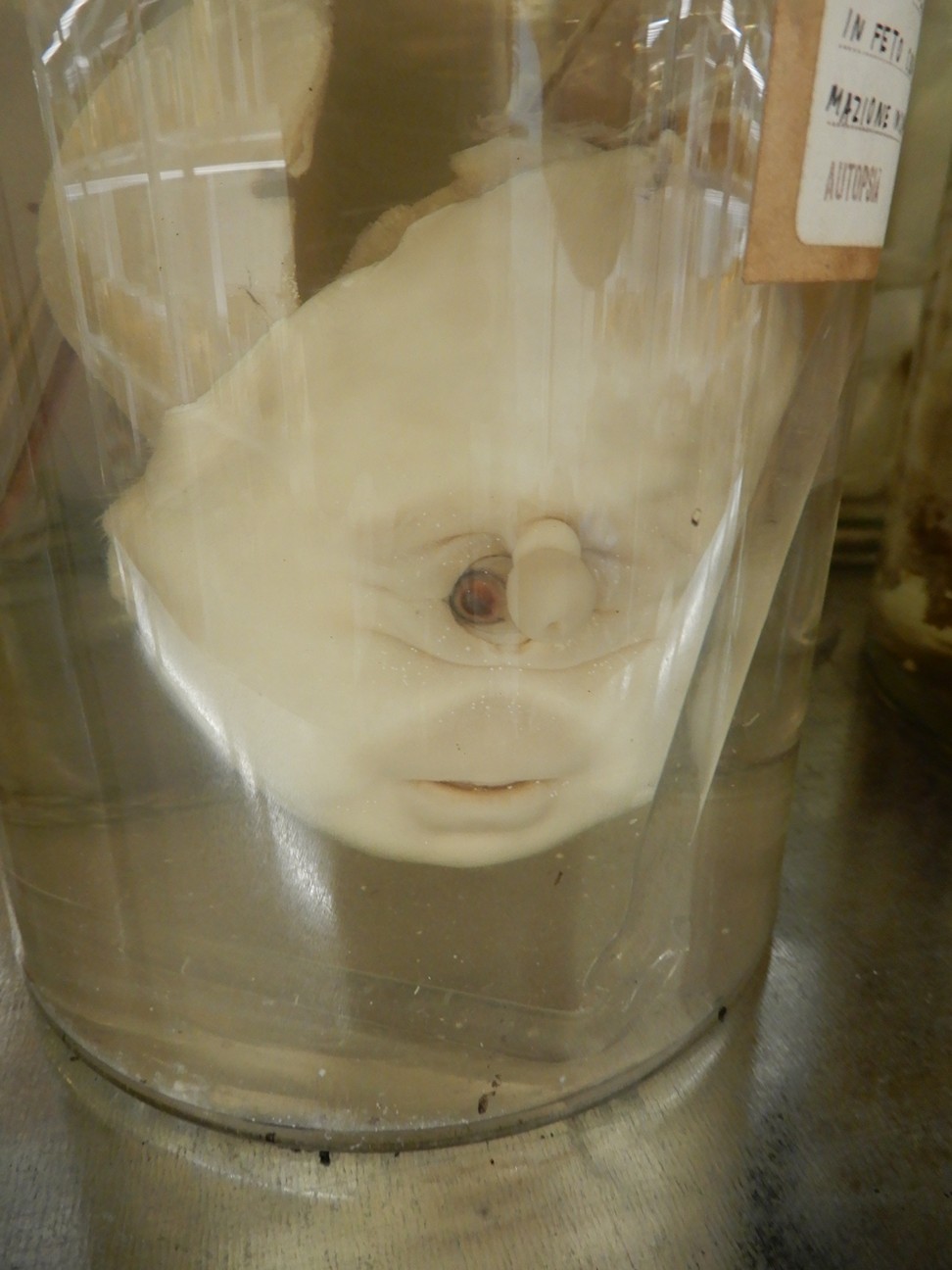 singolo reperto antropologico, preparato anatomico (morfologia alterata per patologia) (XIX-XX)