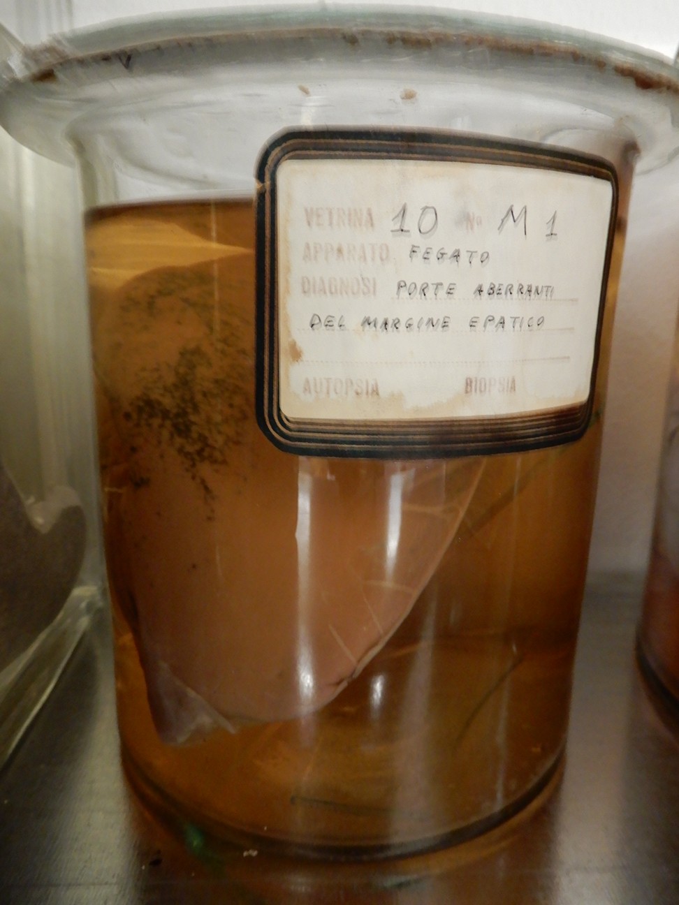 singolo reperto antropologico, preparato anatomico (morfologia alterata per patologia) (XIX-XX)