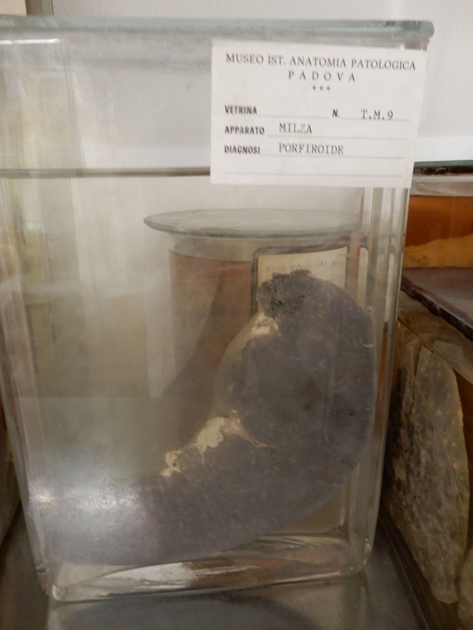 singolo reperto antropologico, preparato anatomico (morfologia alterata per patologia) (XIX-XX)