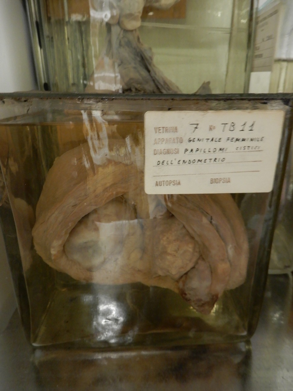 singolo reperto antropologico, preparato anatomico (morfologia alterata per patologia) (XIX-XX)