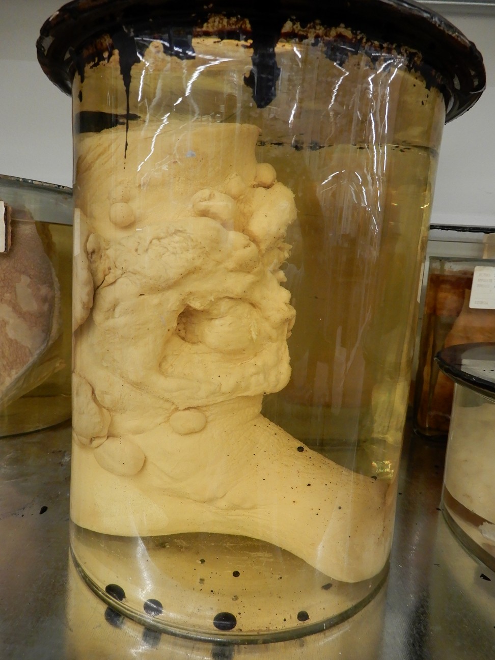 singolo reperto antropologico, preparato anatomico (morfologia alterata per patologia) (XIX-XX)