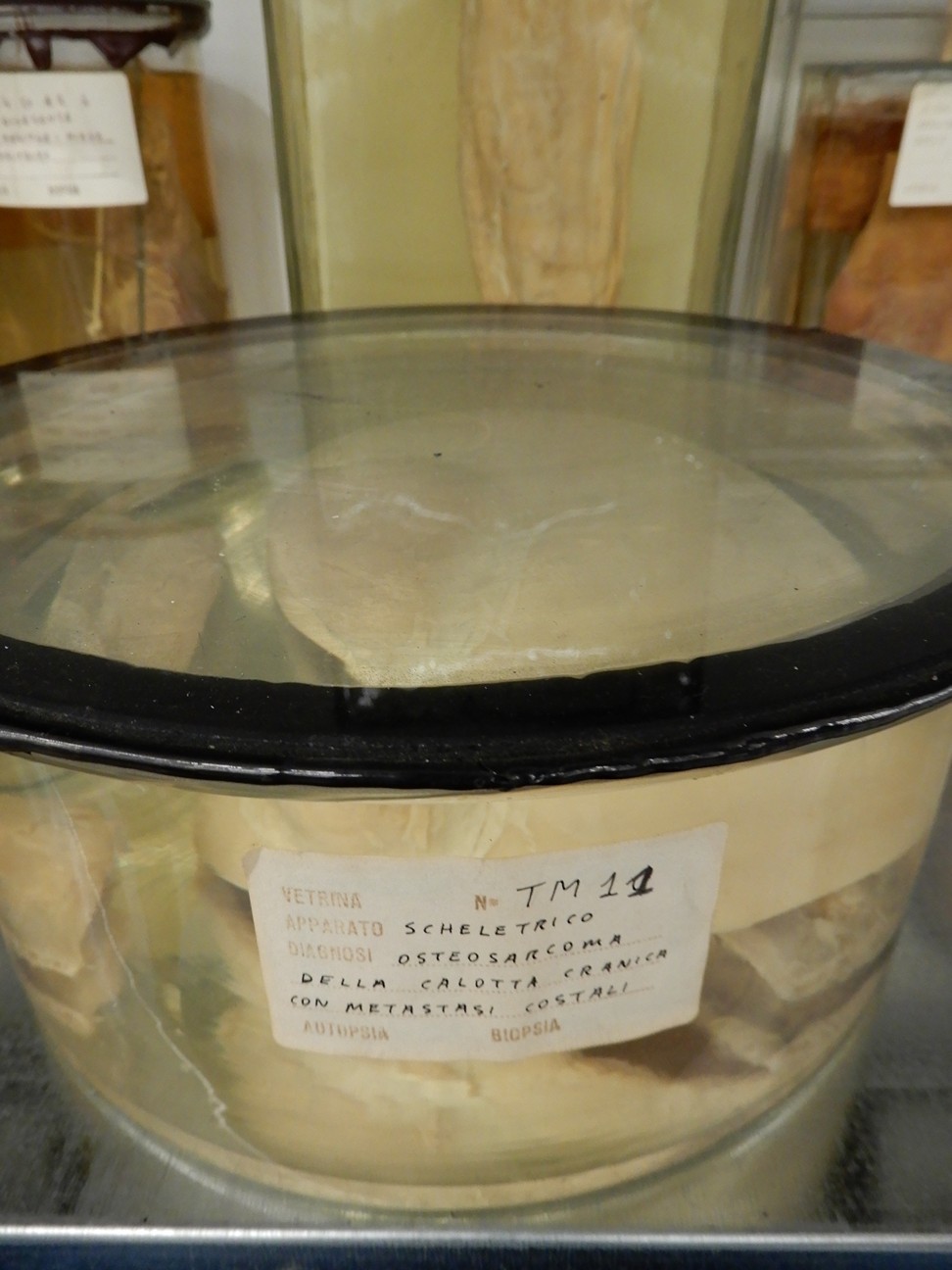 singolo reperto antropologico, preparato anatomico (morfologia alterata per patologia) (XIX-XX)