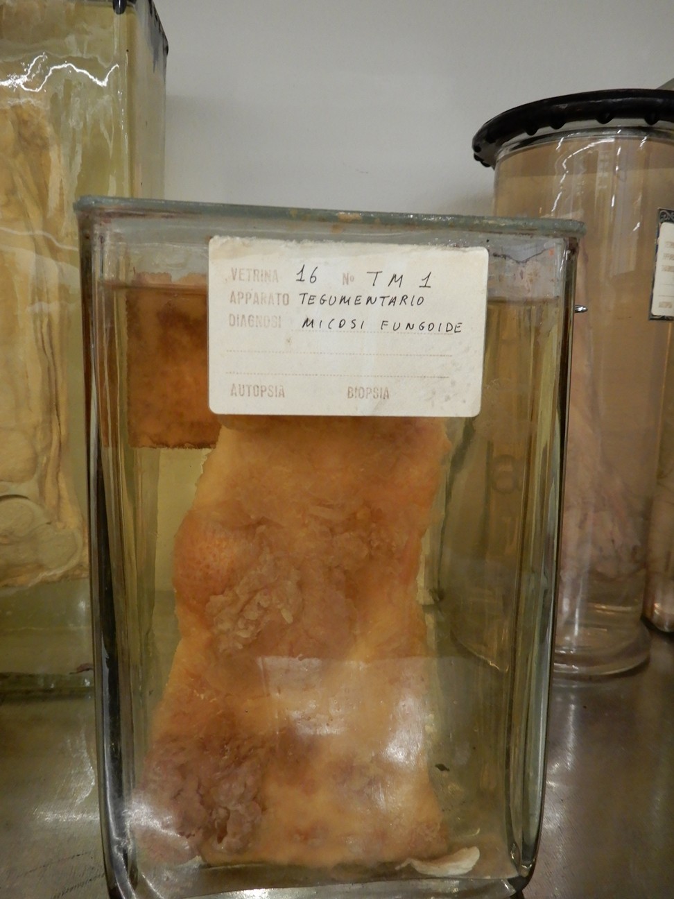 singolo reperto antropologico, preparato anatomico (morfologia alterata per patologia) (XIX-XX)