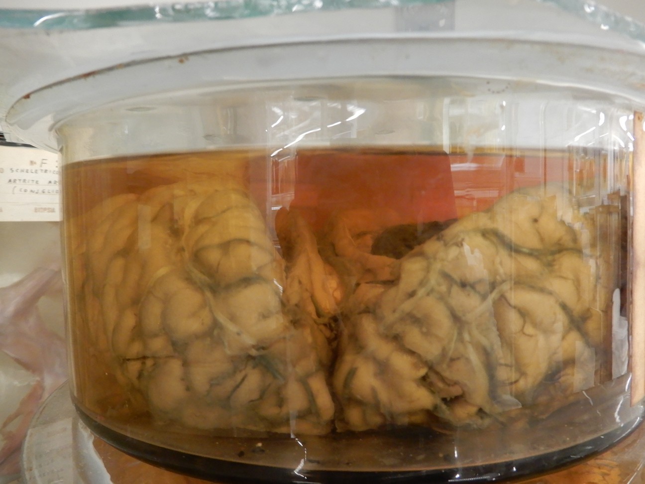 singolo reperto antropologico, preparato anatomico (morfologia alterata per patologia) (XIX-XX)