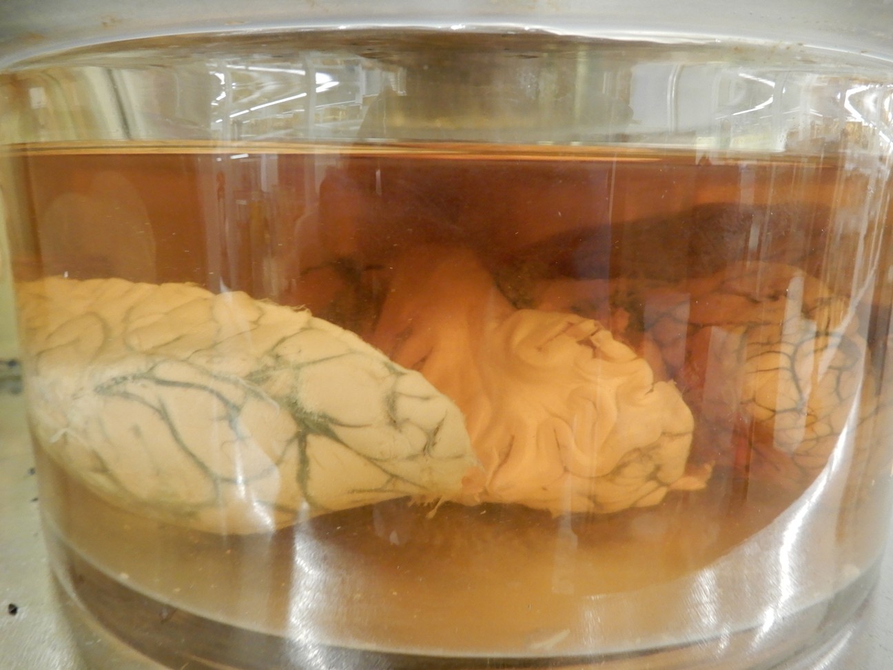 singolo reperto antropologico, preparato anatomico (morfologia alterata per patologia) (XIX-XX)