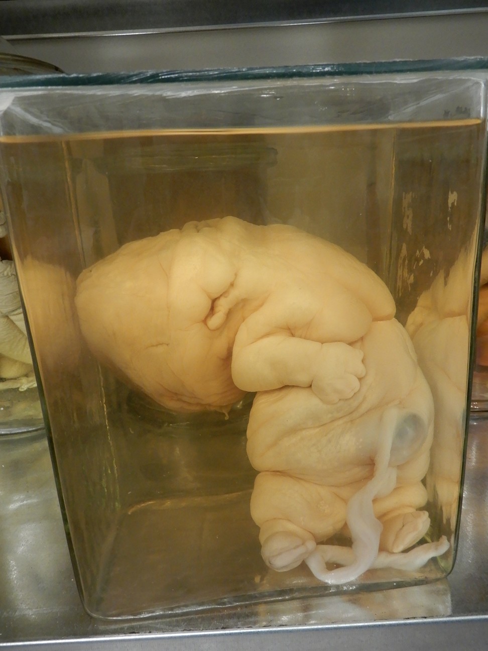 singolo reperto antropologico, preparato anatomico (morfologia alterata per patologia) (XIX-XX)