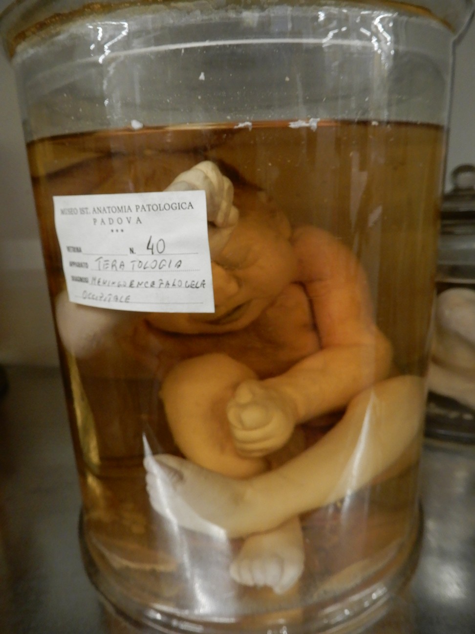 singolo reperto antropologico, preparato anatomico (morfologia alterata per patologia) (XIX-XX)