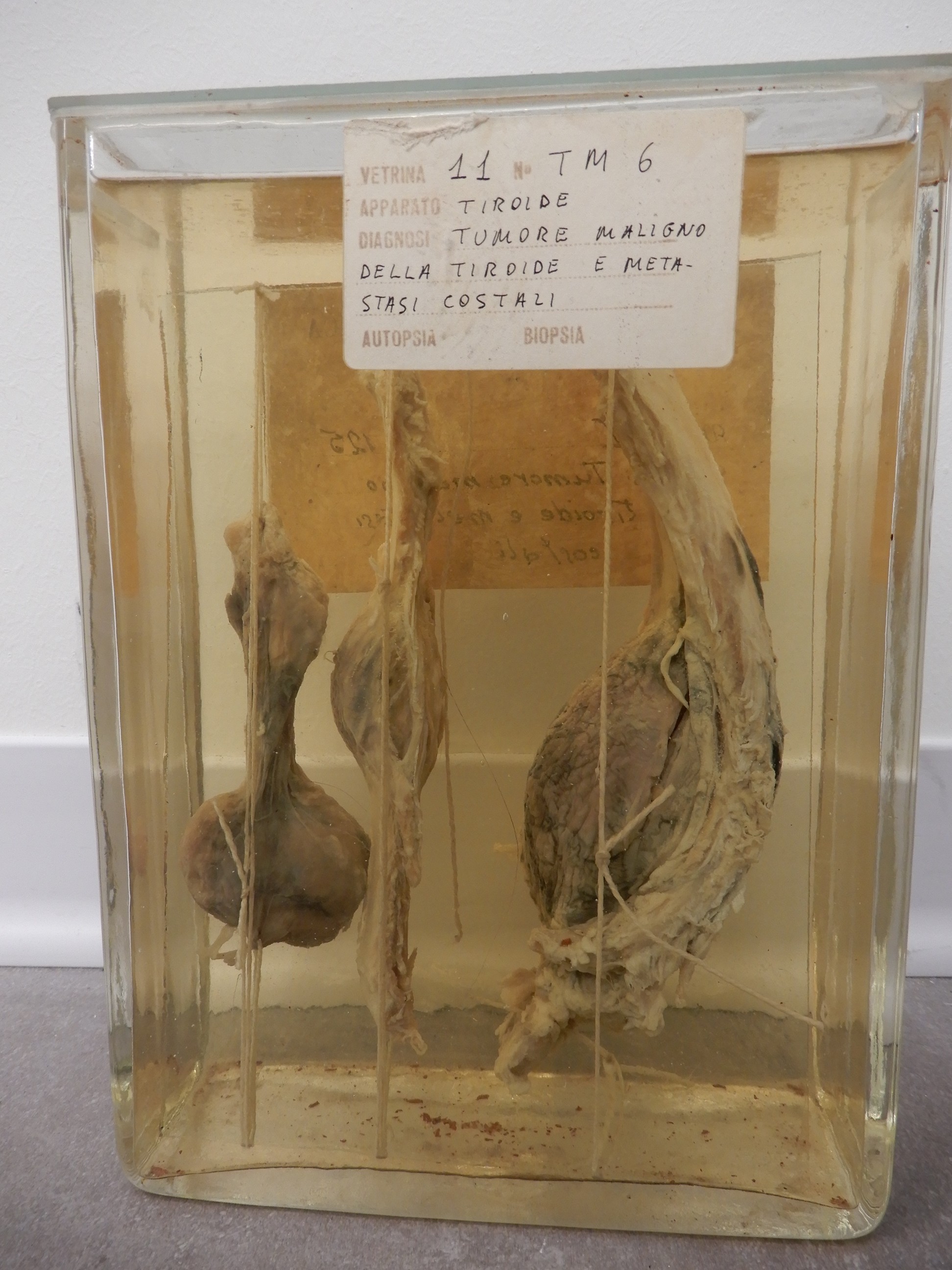 singolo reperto antropologico, preparato anatomico (morfologia alterata per patologia) (XIX-XX)