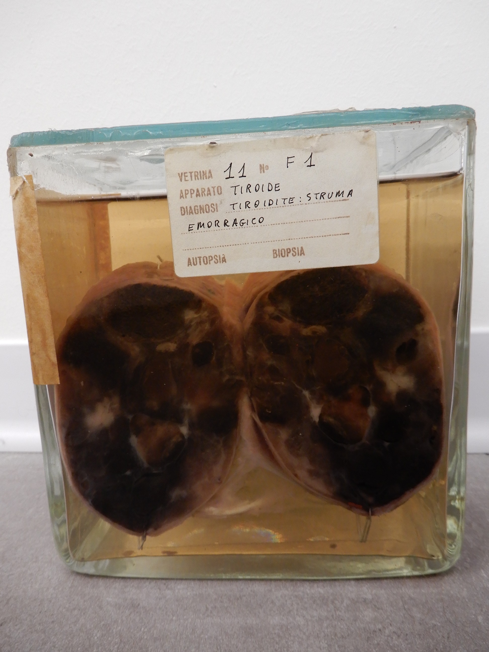 singolo reperto antropologico, preparato anatomico (morfologia alterata per patologia) (XIX-XX)