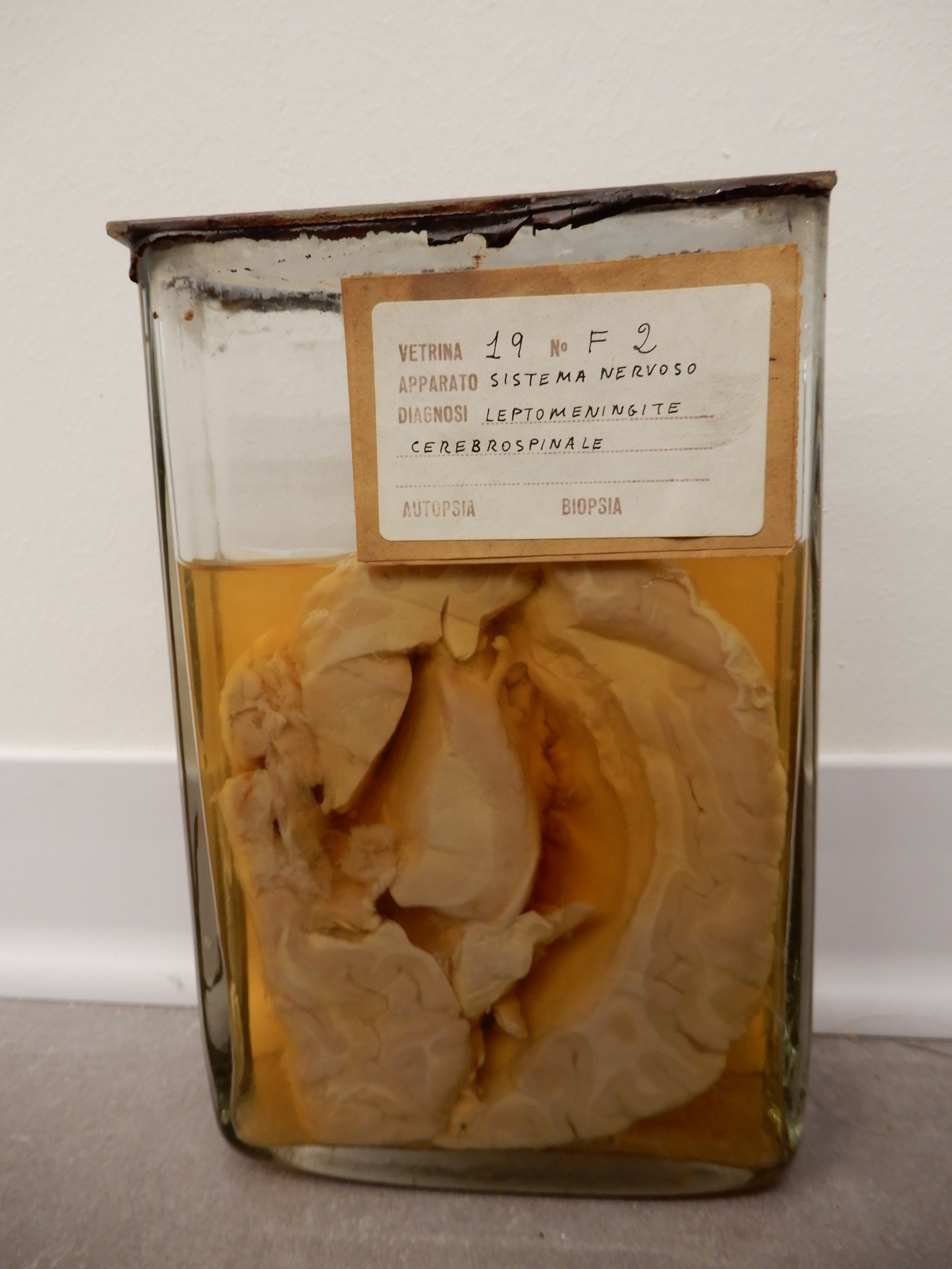 singolo reperto antropologico, preparato anatomico (morfologia alterata per patologia) (XIX-XX)