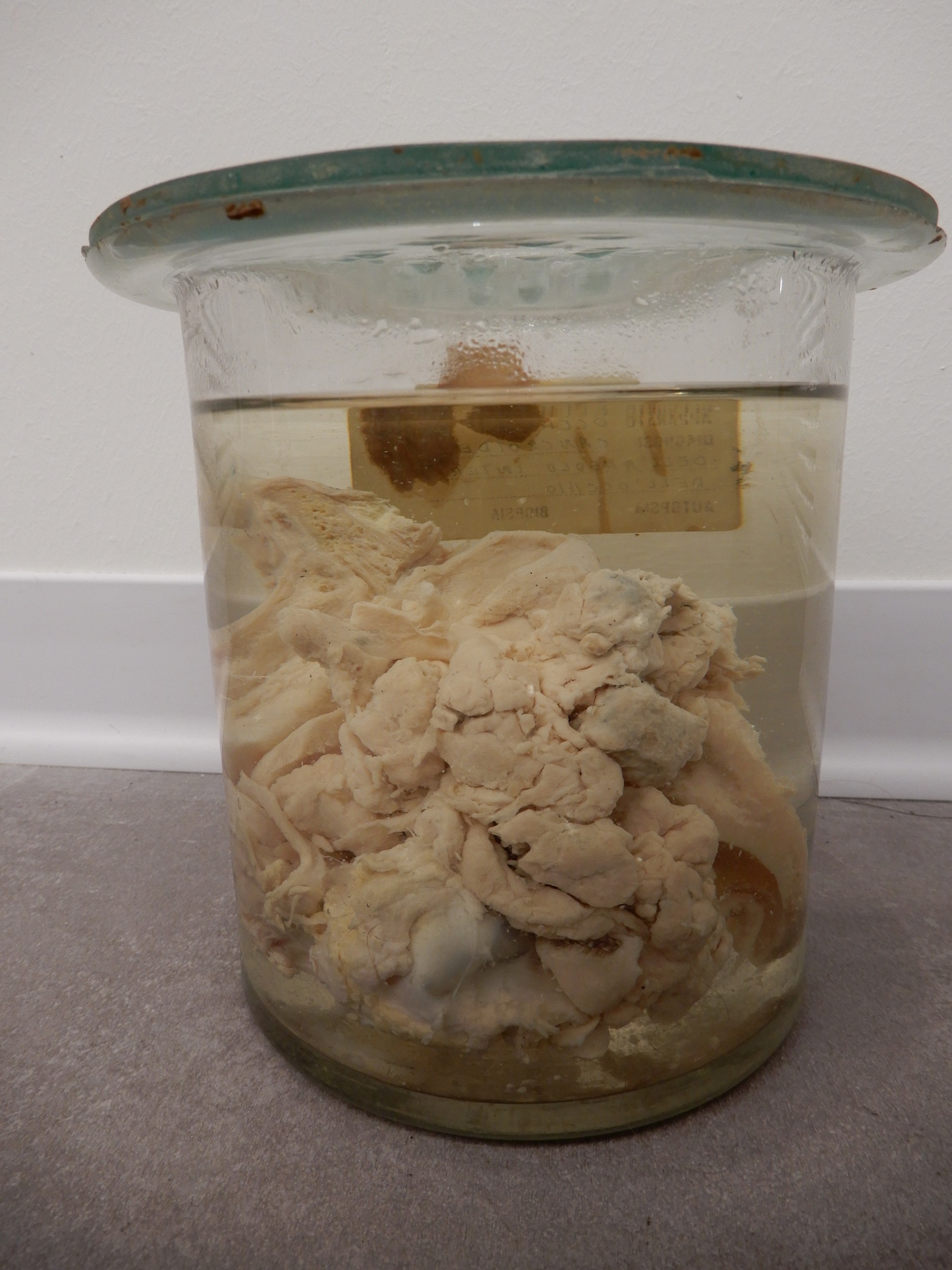 singolo reperto antropologico, preparato anatomico (morfologia alterata per patologia) (XIX-XX)