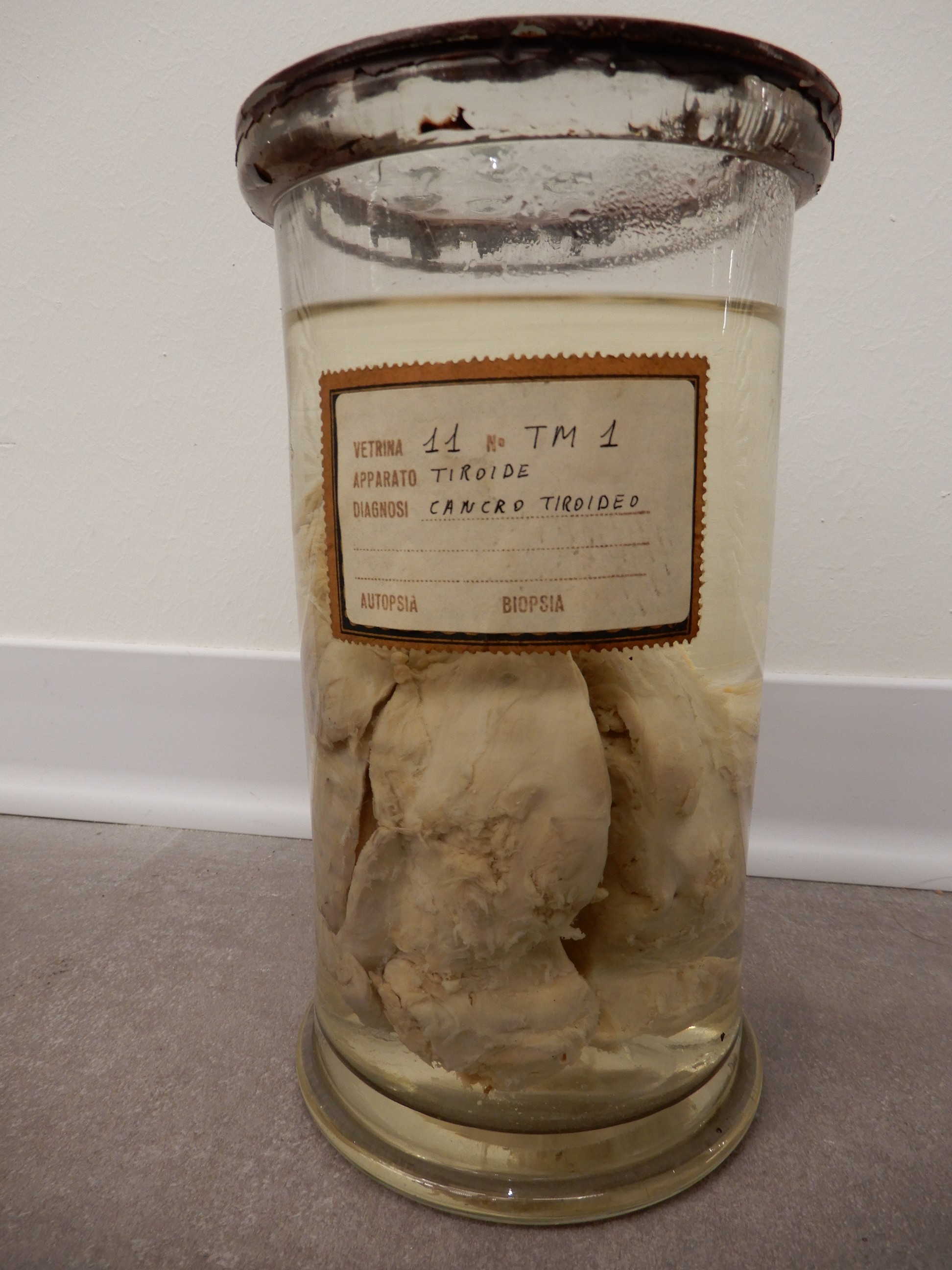 singolo reperto antropologico, preparato anatomico (morfologia alterata per patologia) (XIX-XX)