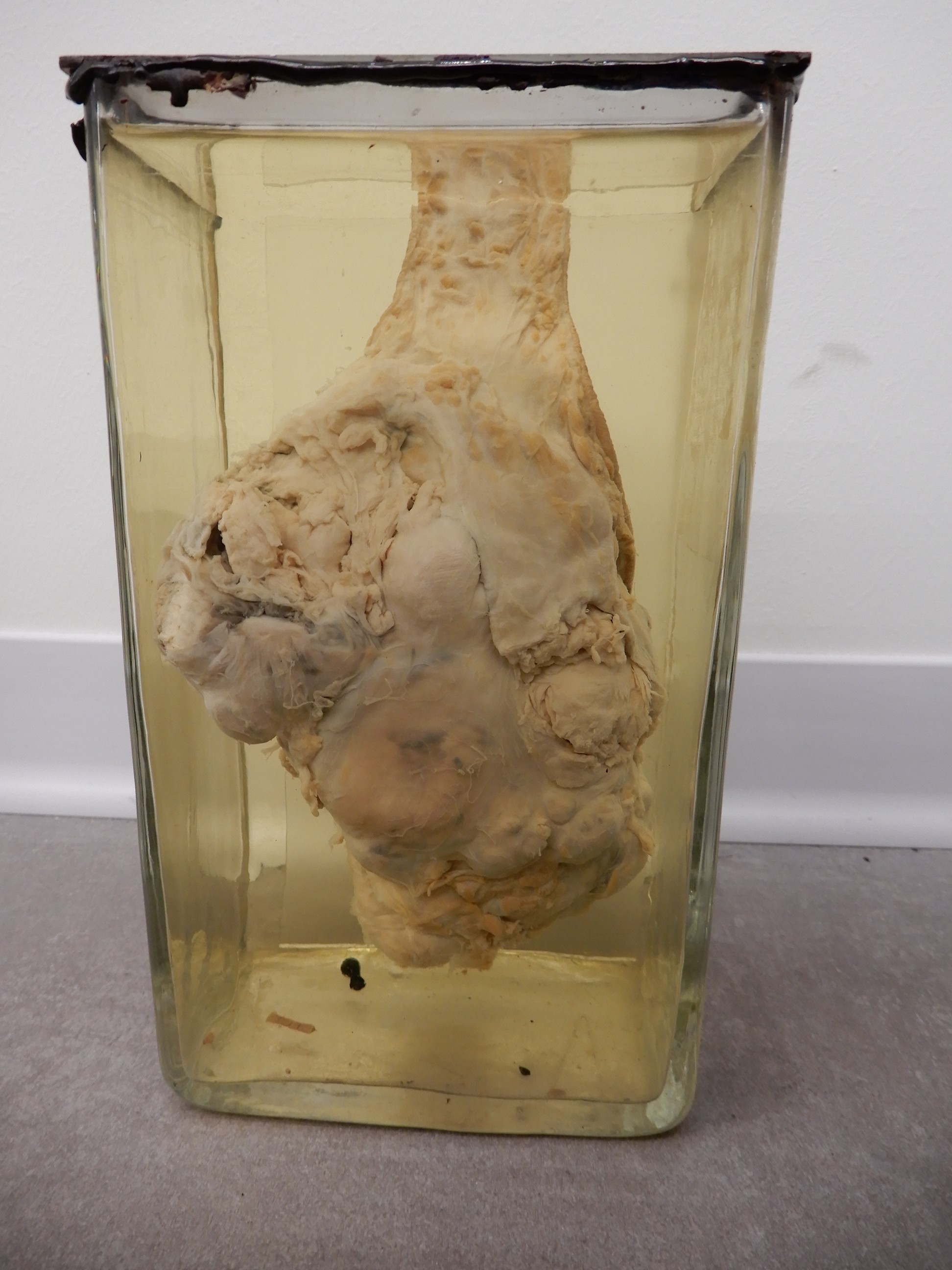 singolo reperto antropologico, preparato anatomico (morfologia alterata per patologia) (XIX-XX)