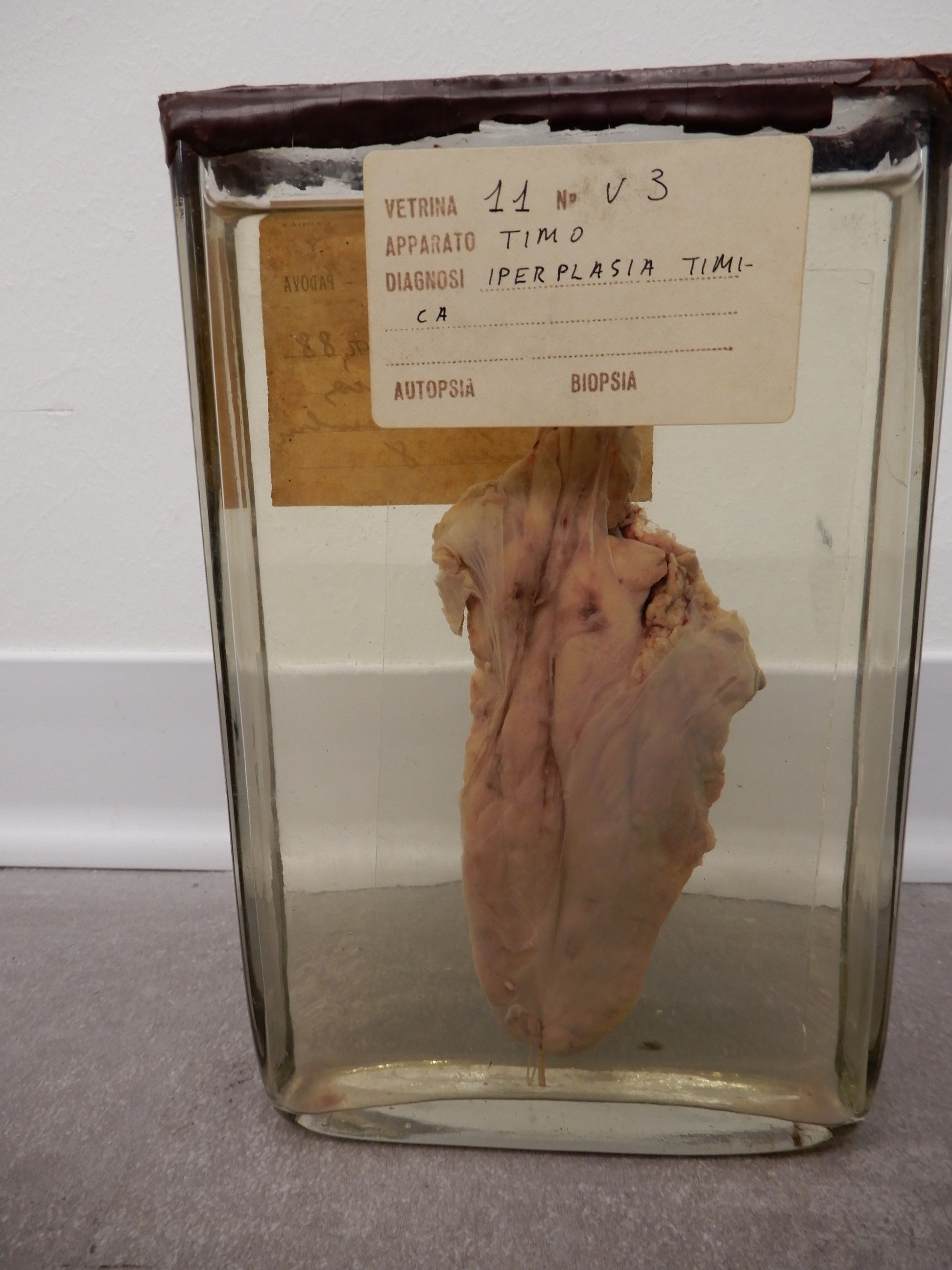 singolo reperto antropologico, preparato anatomico (morfologia alterata per patologia) (XIX-XX)