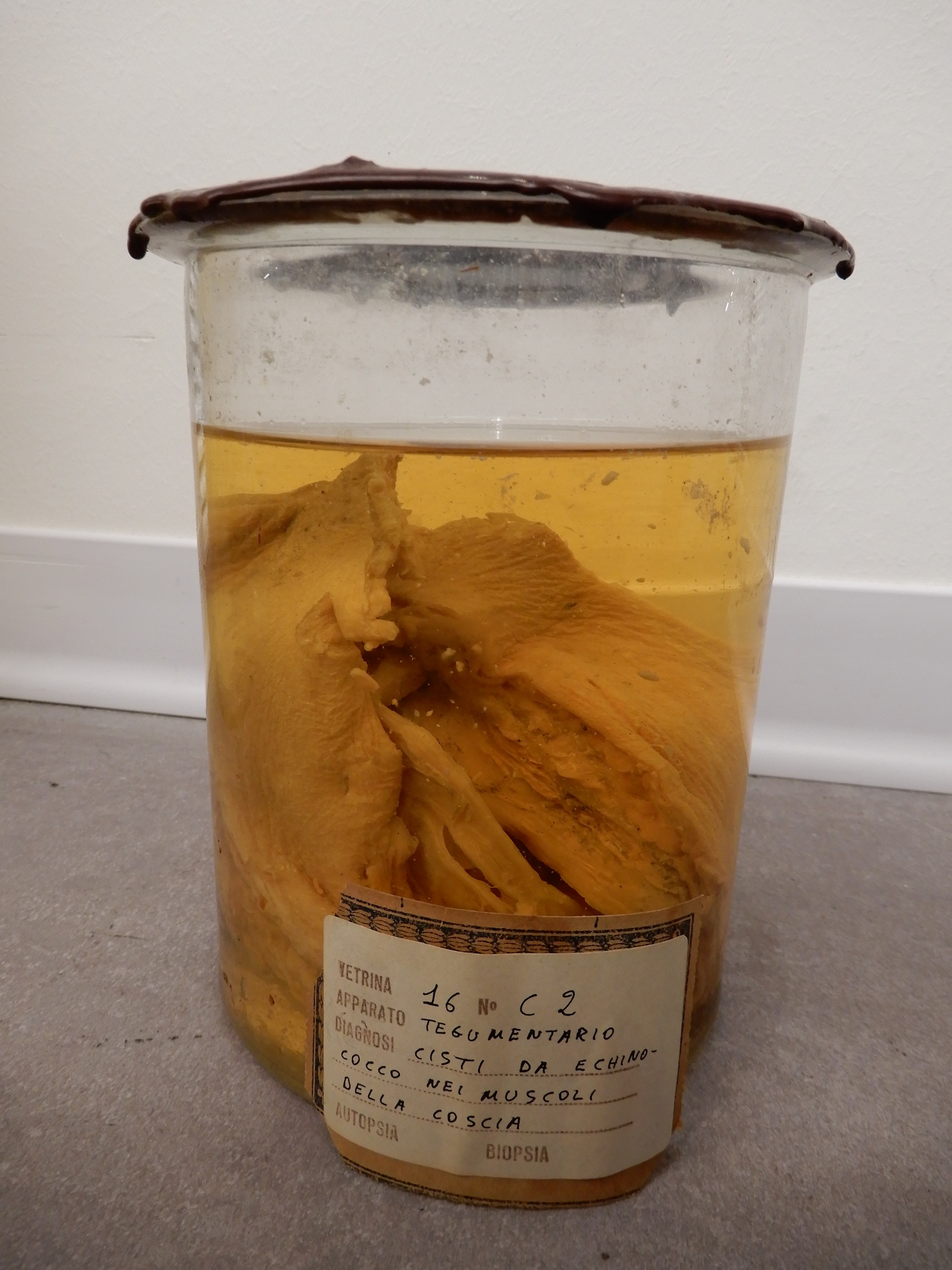 singolo reperto antropologico, preparato anatomico (morfologia alterata per patologia) (XIX-XX)