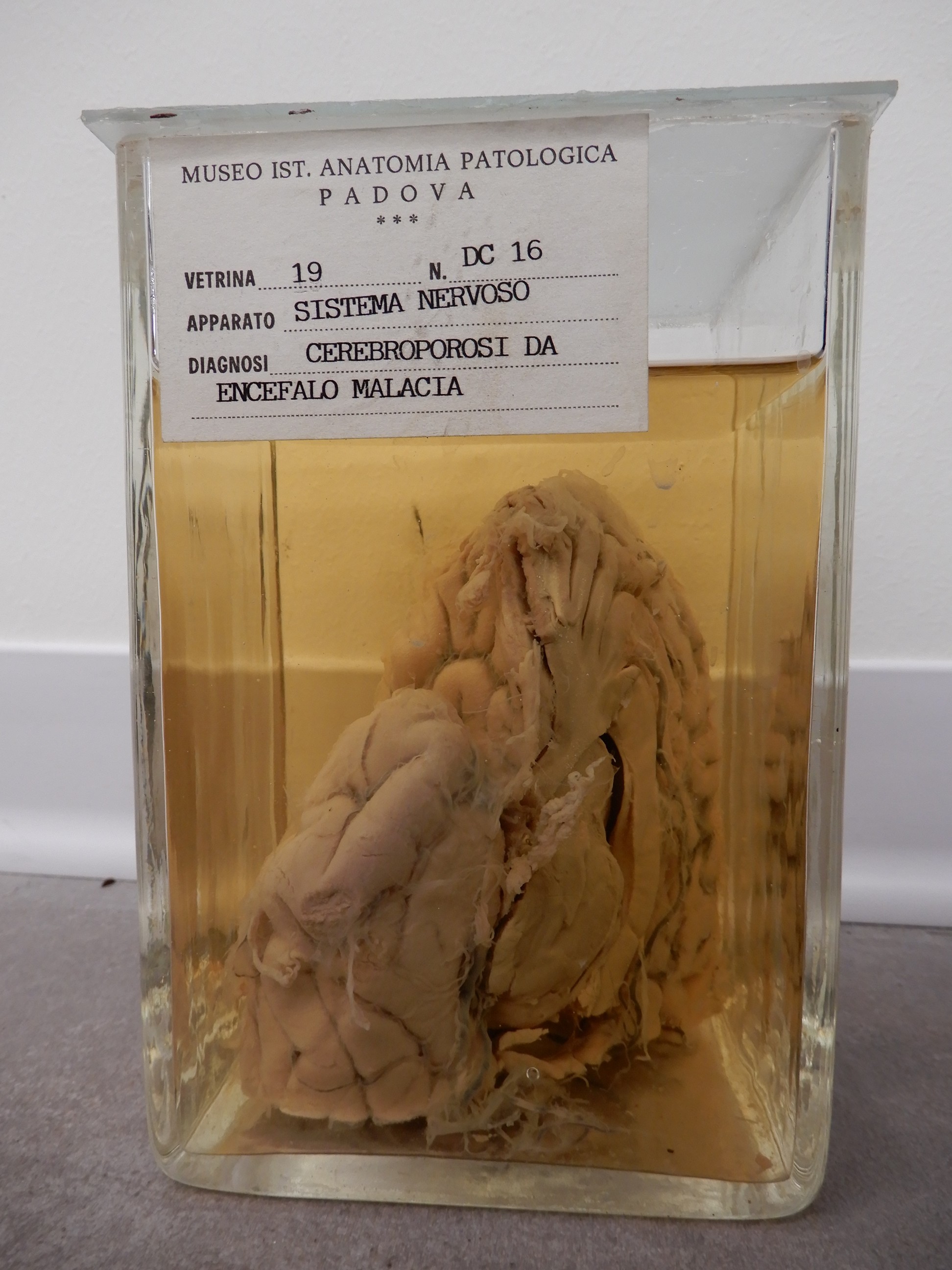 singolo reperto antropologico, preparato anatomico (morfologia alterata per patologia) (XIX-XX)