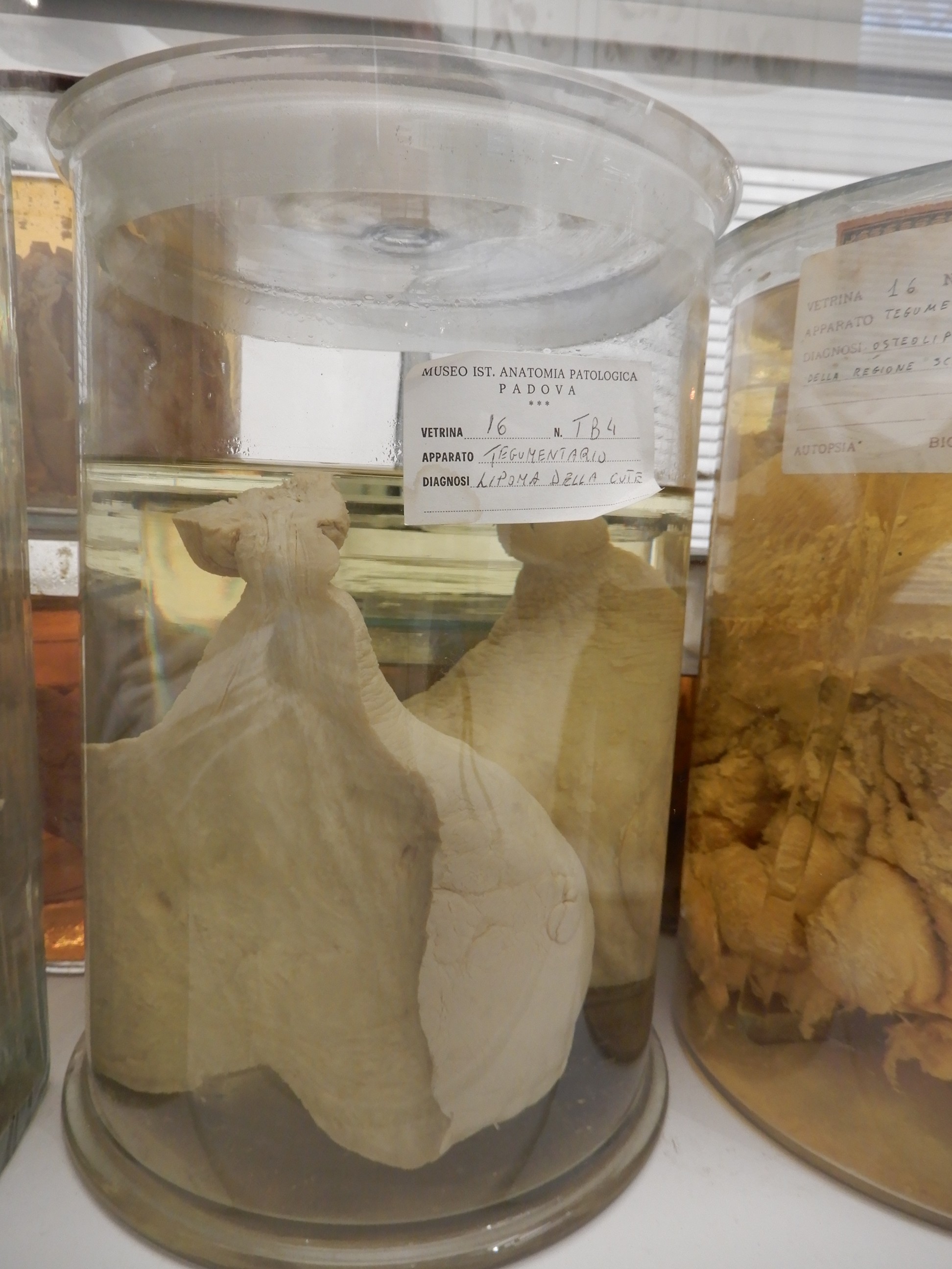 singolo reperto antropologico, preparato anatomico (morfologia alterata per patologia) (XIX-XX)