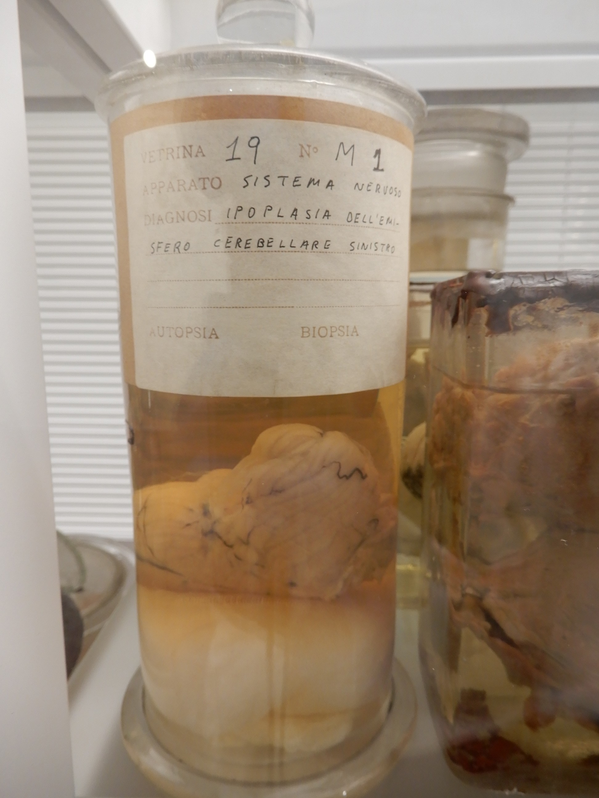 singolo reperto antropologico, preparato anatomico (morfologia alterata per patologia) (XIX-XX)