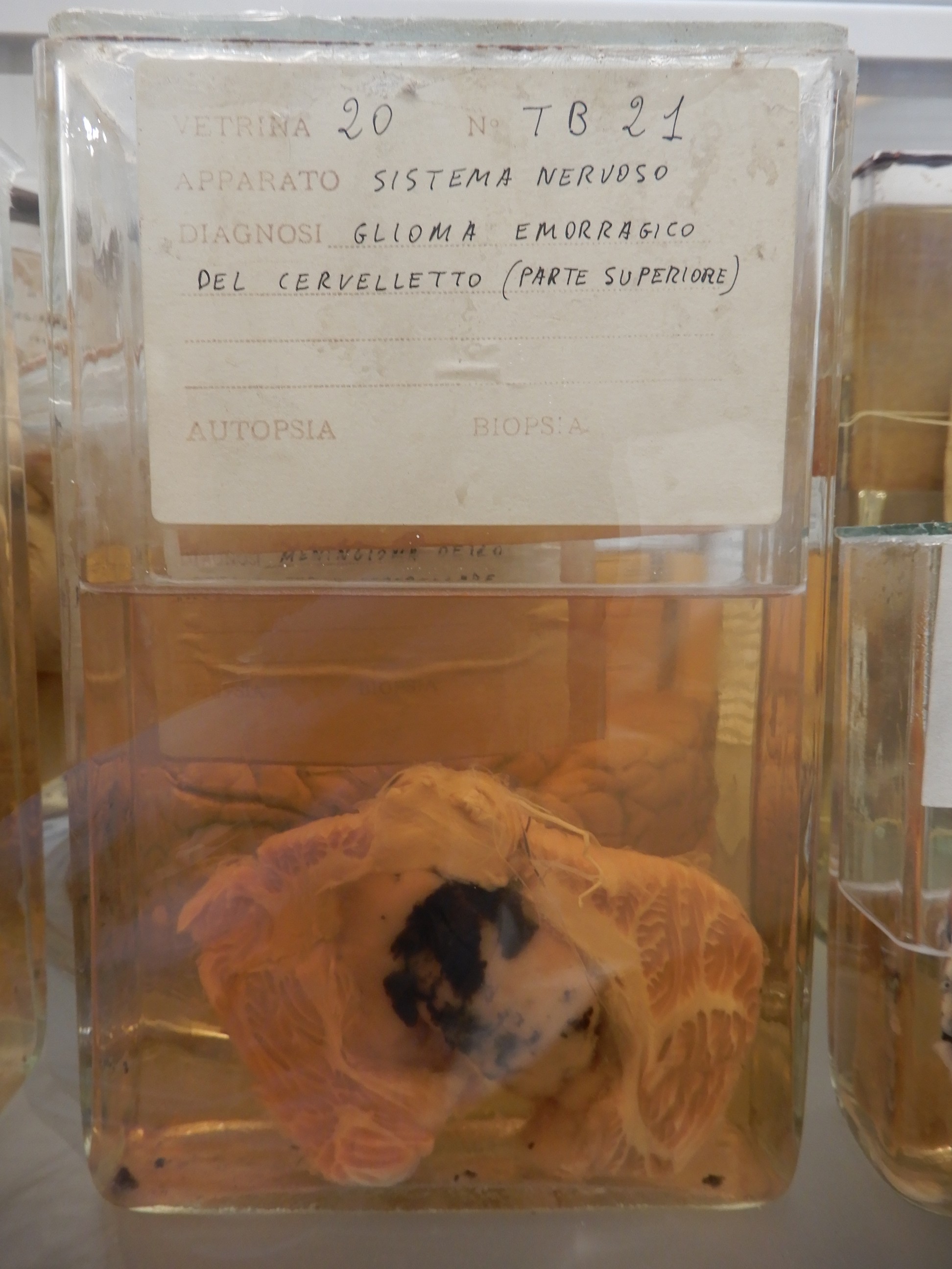 singolo reperto antropologico, preparato anatomico (morfologia alterata per patologia) (XIX-XX)