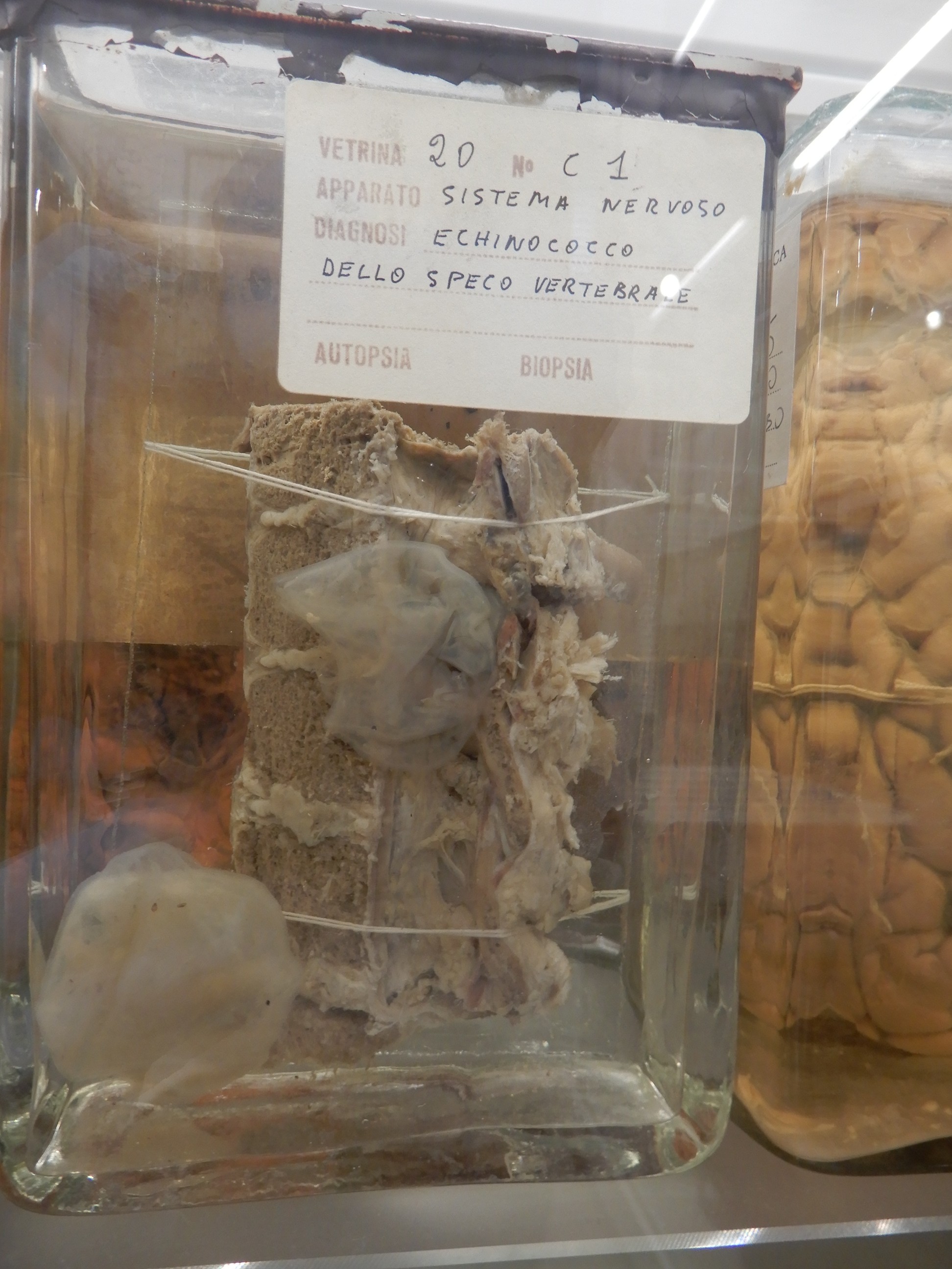 singolo reperto antropologico, preparato anatomico (morfologia alterata per patologia) (XIX-XX)