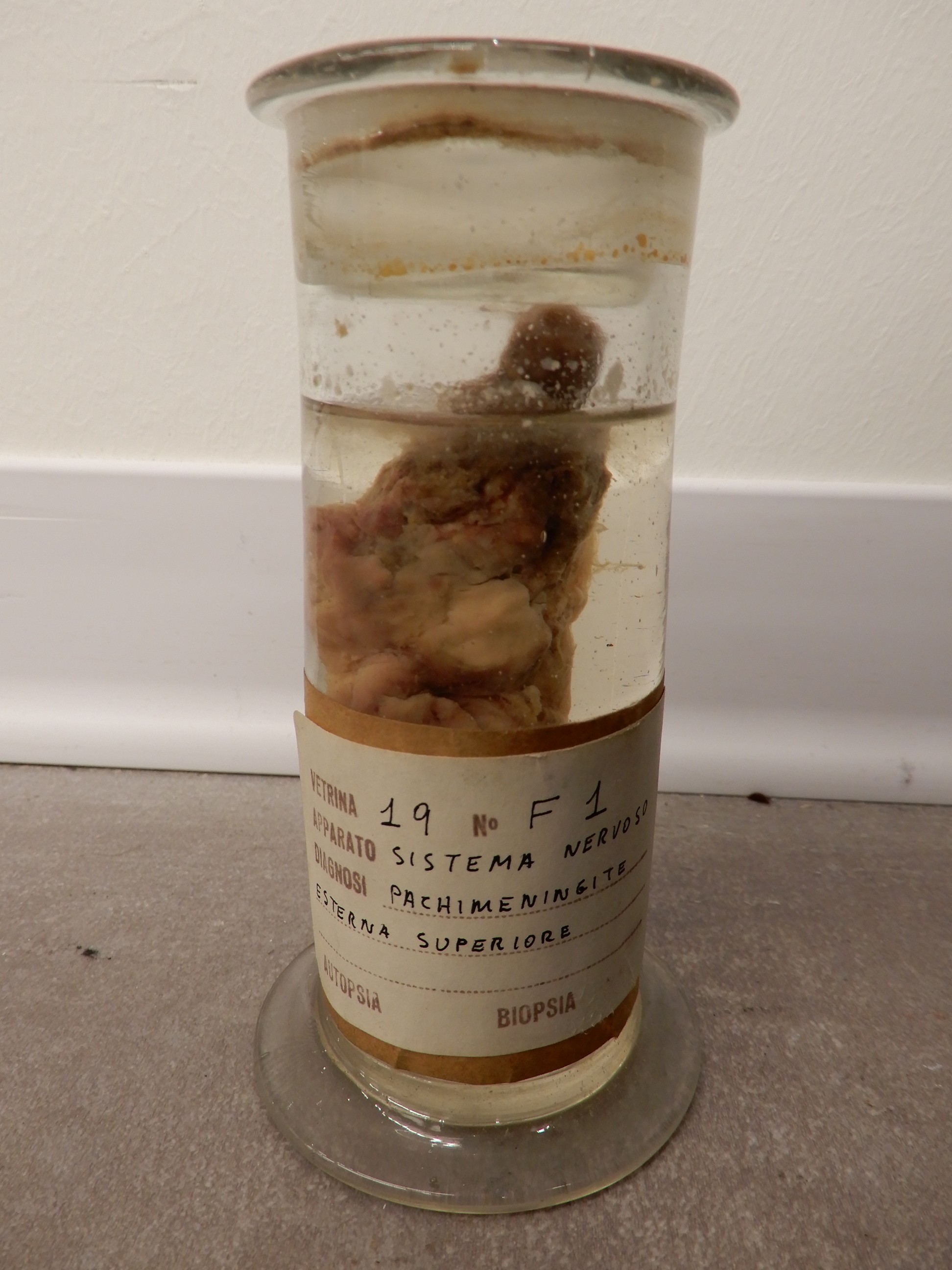 singolo reperto antropologico, preparato anatomico (morfologia alterata per patologia) (XIX-XX)