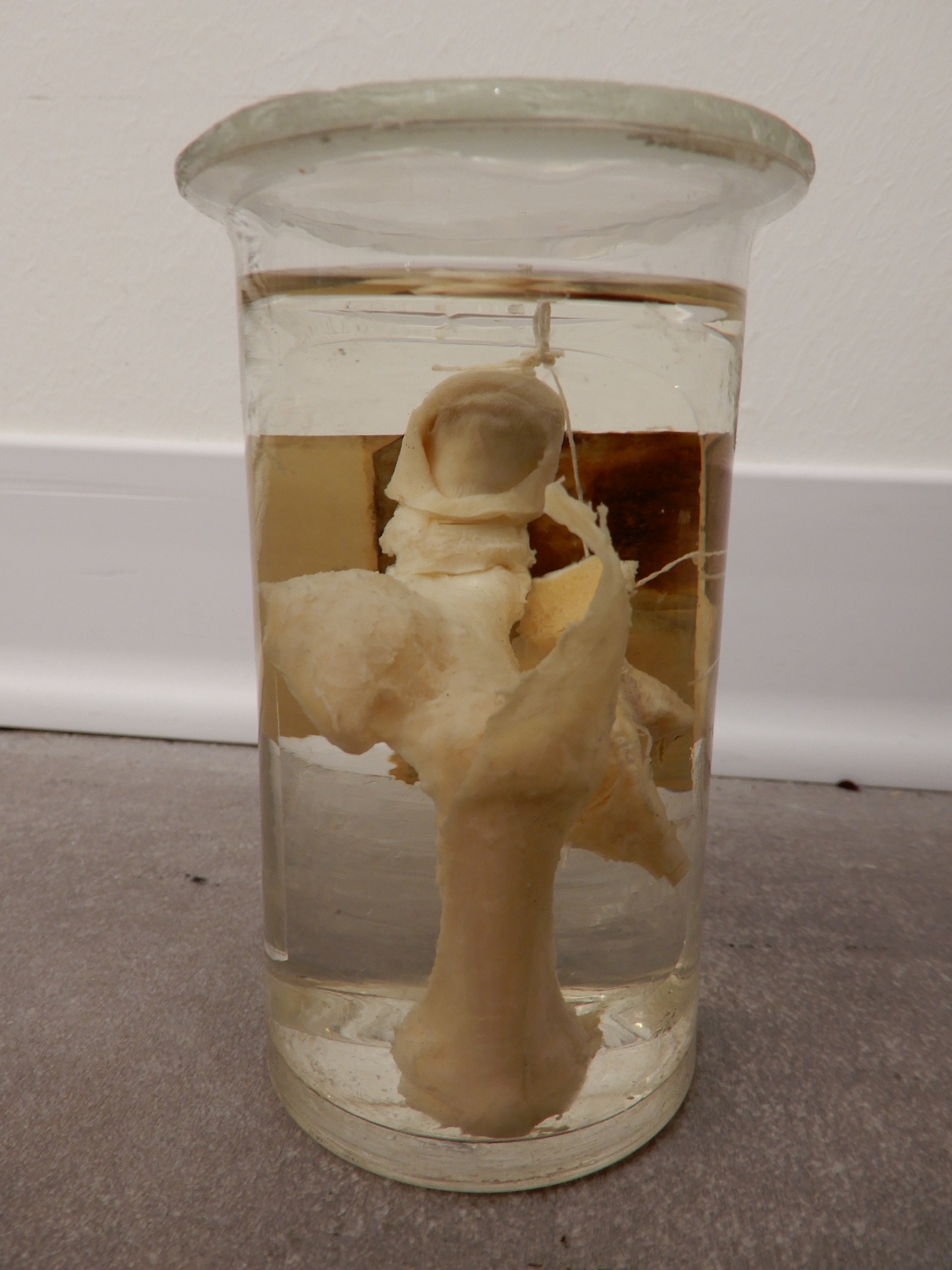 singolo reperto antropologico, preparato anatomico (morfologia alterata per patologia) (XIX-XX)