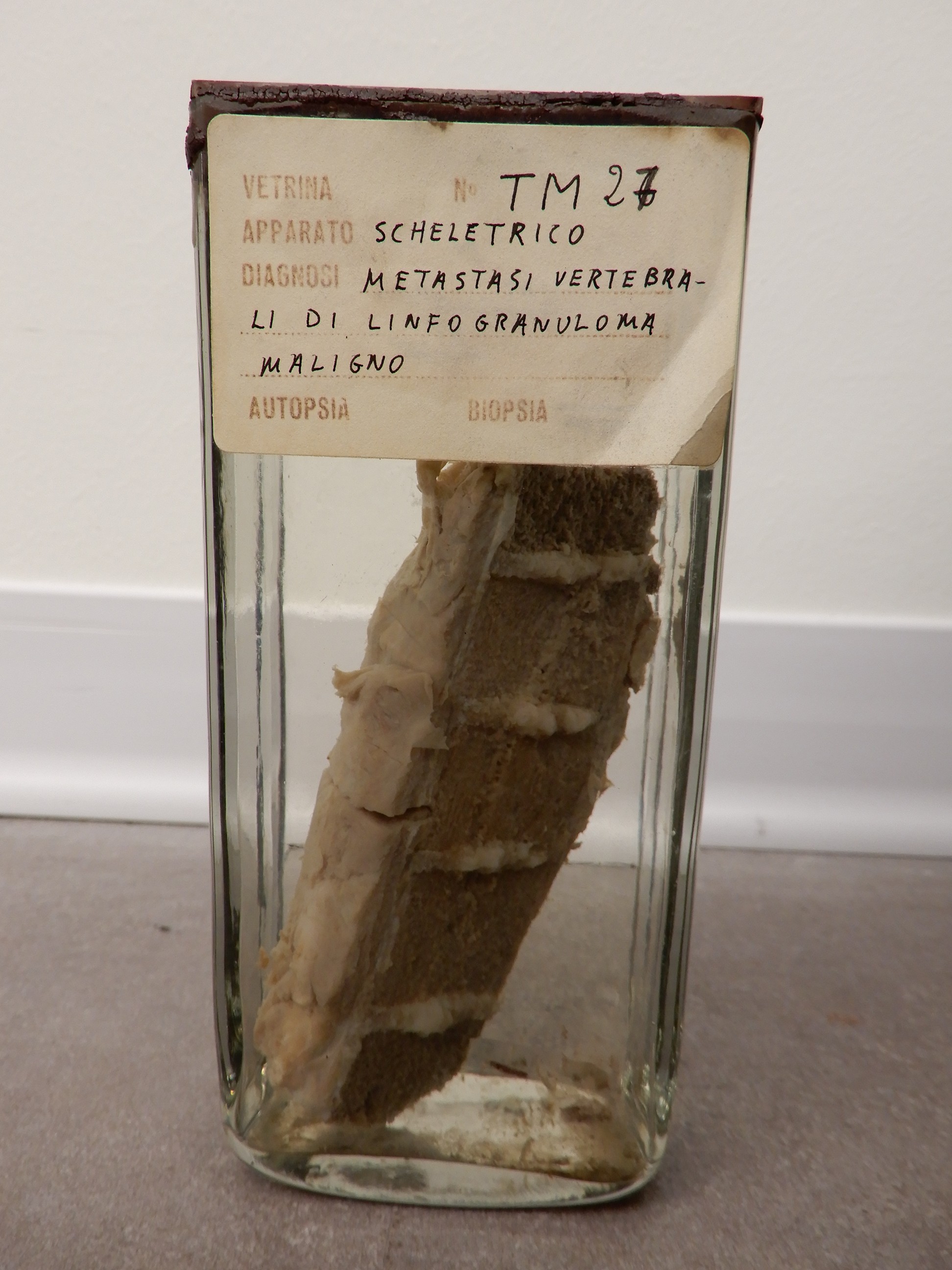 singolo reperto antropologico, preparato anatomico (morfologia alterata per patologia) (XIX-XX)