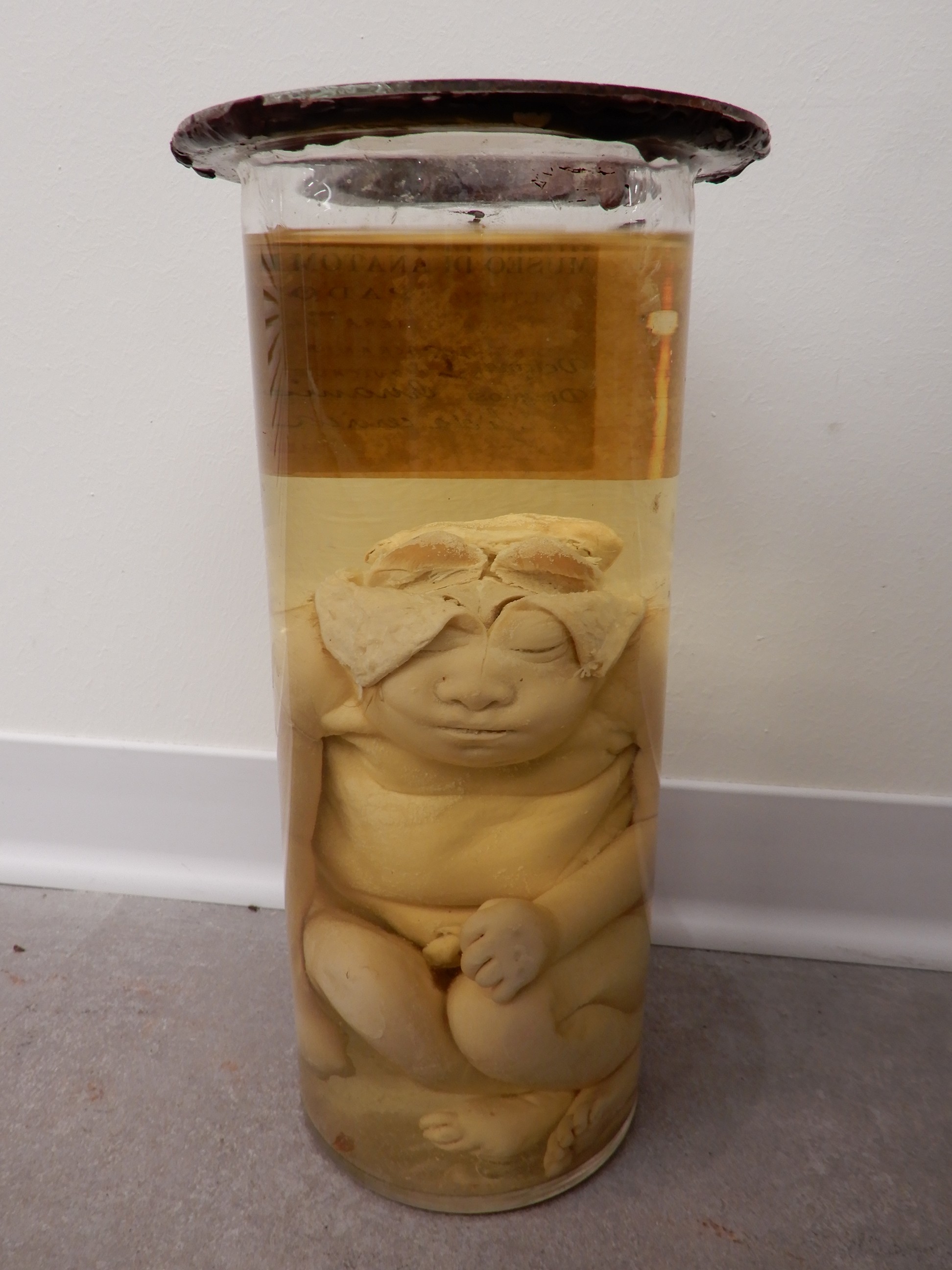 singolo reperto antropologico, preparato anatomico (morfologia alterata per patologia) (XIX-XX)