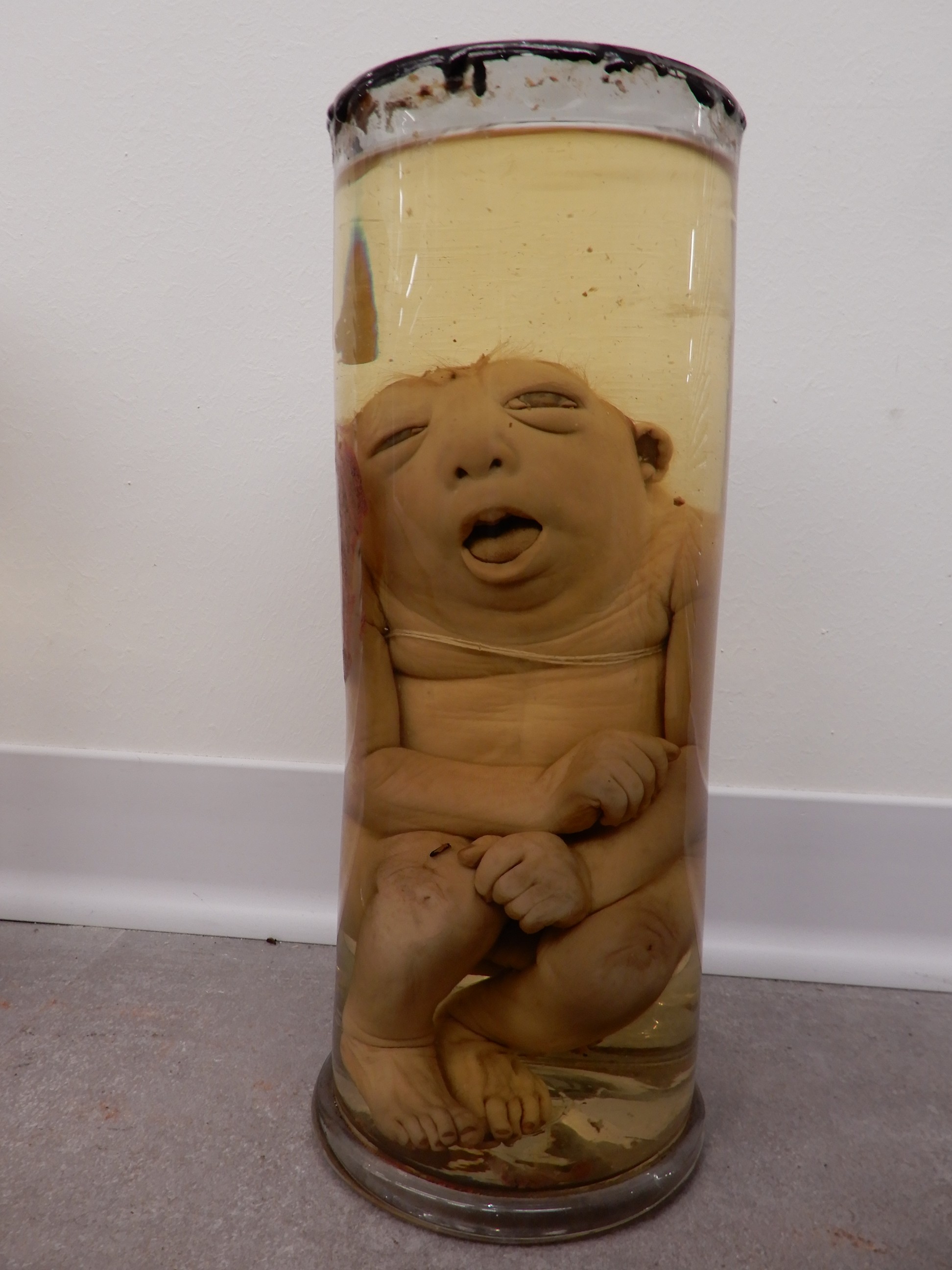 singolo reperto antropologico, preparato anatomico (morfologia alterata per patologia) (XIX-XX)