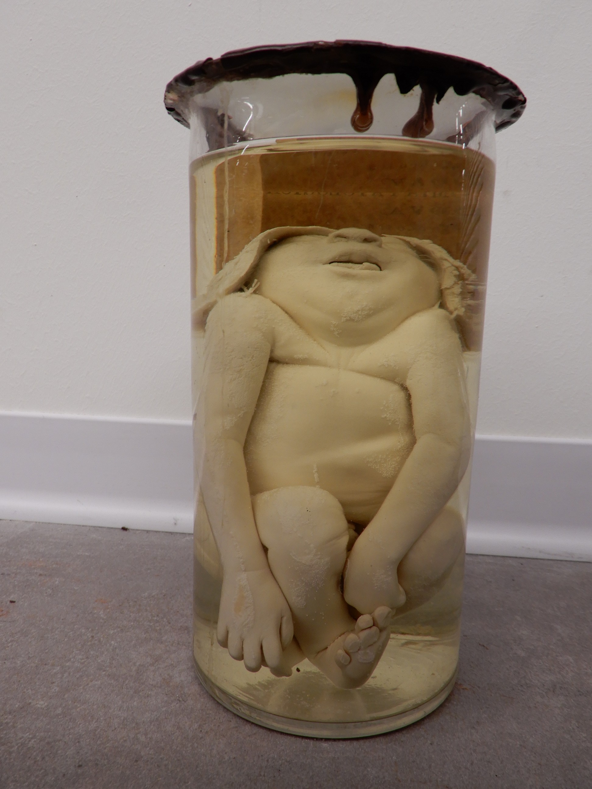 singolo reperto antropologico, preparato anatomico (morfologia alterata per patologia) (XIX-XX)