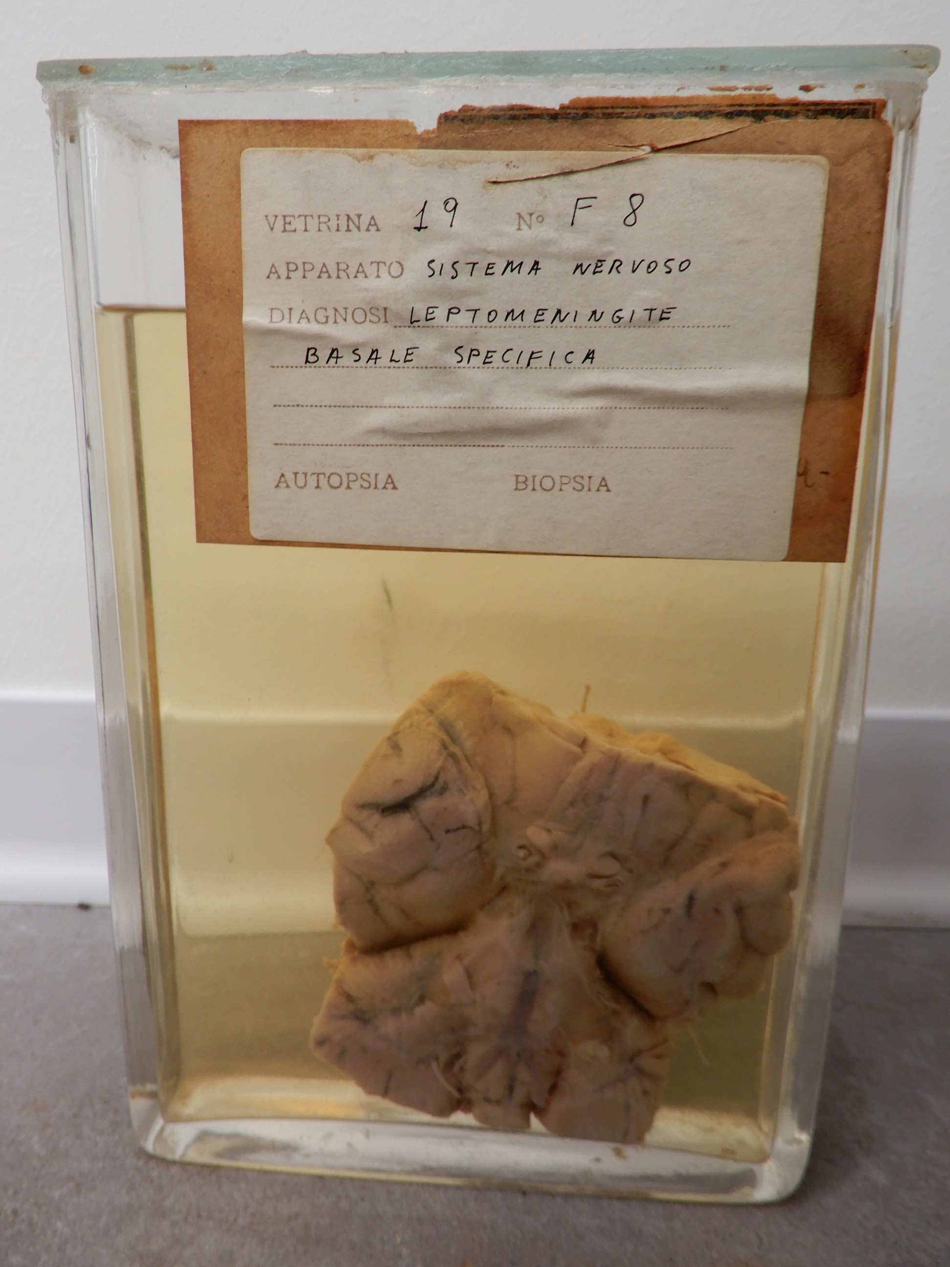 singolo reperto antropologico, preparato anatomico (morfologia alterata per patologia) (XIX-XX)