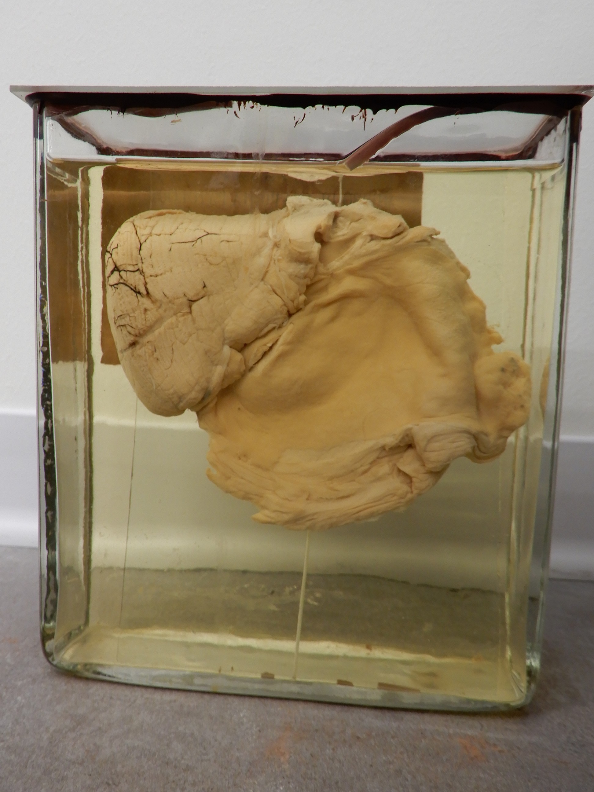 singolo reperto antropologico, preparato anatomico (morfologia alterata per patologia) (XIX-XX)