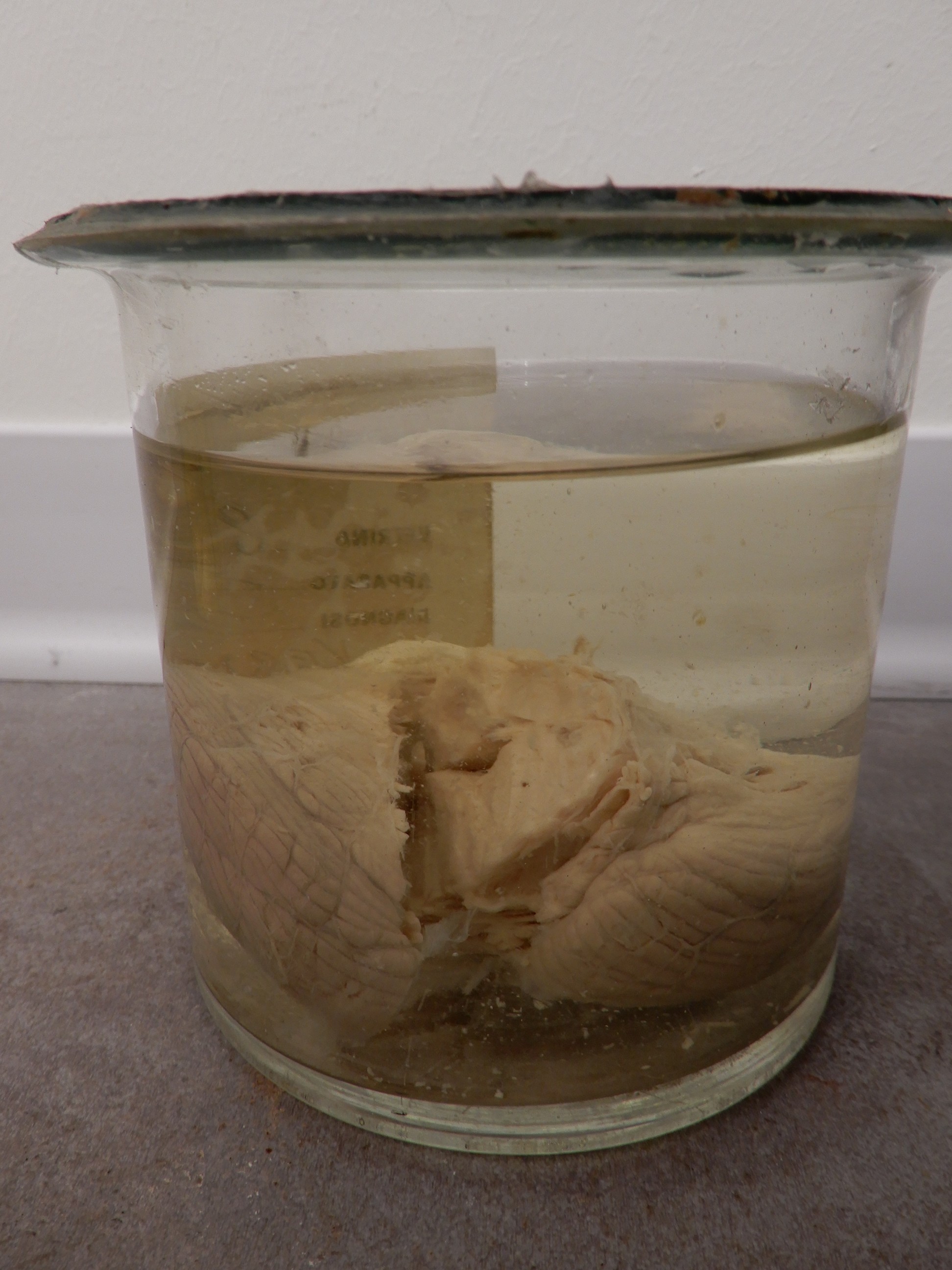 singolo reperto antropologico, preparato anatomico (morfologia alterata per patologia) (XIX-XX)