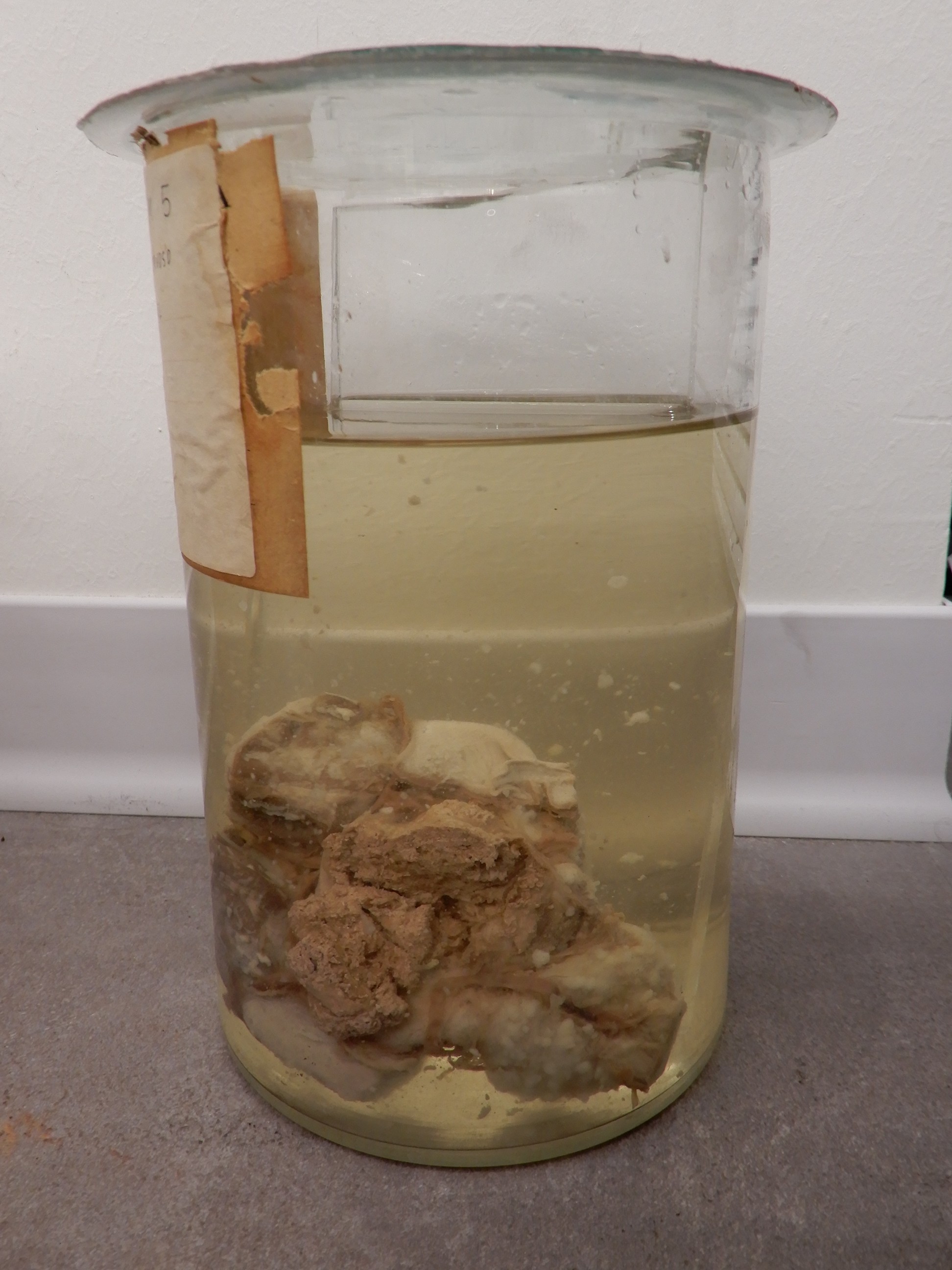 singolo reperto antropologico, preparato anatomico (morfologia alterata per patologia) (XIX-XX)