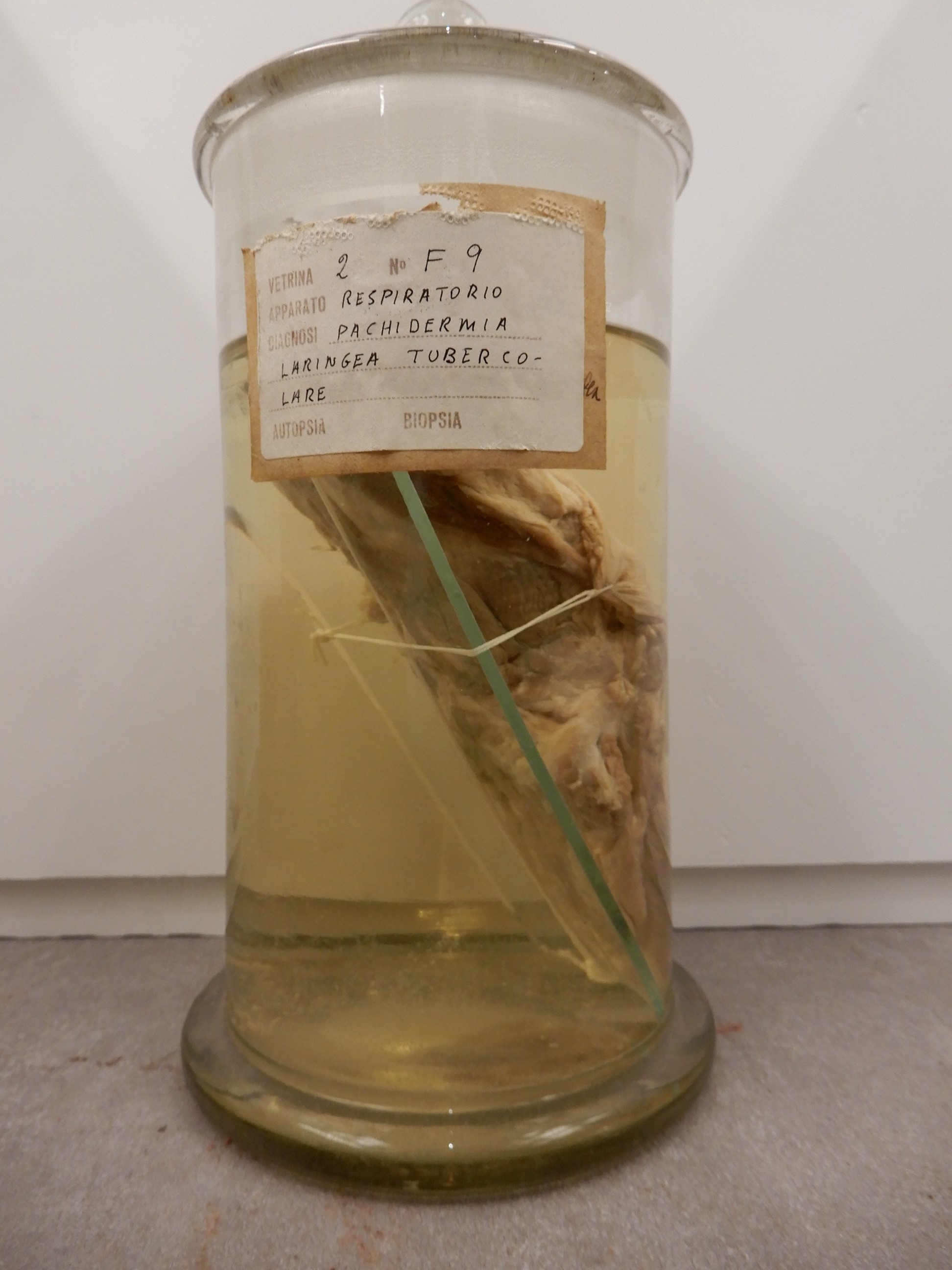 singolo reperto antropologico, preparato anatomico (morfologia alterata per patologia) (XIX-XX)