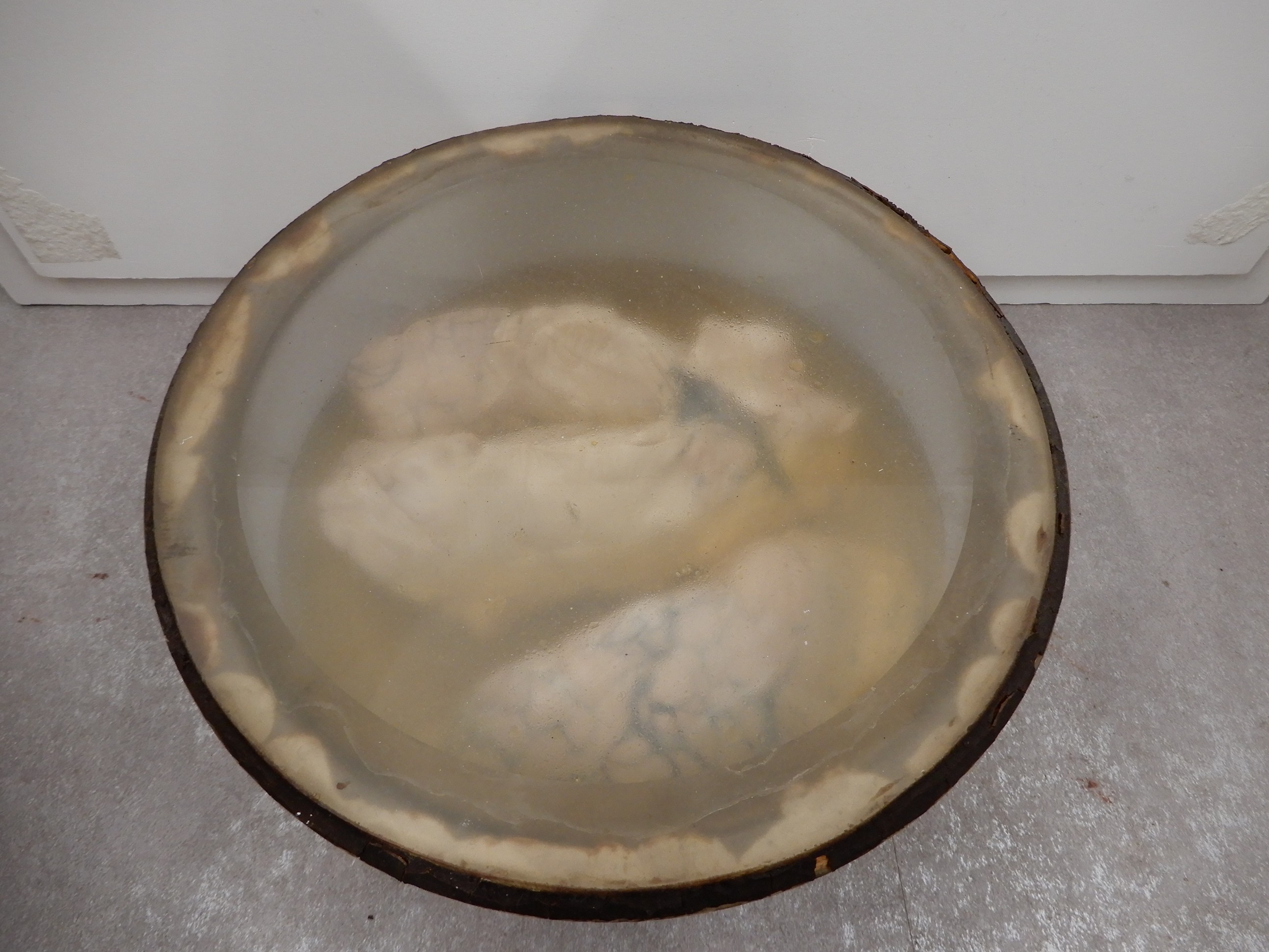 singolo reperto antropologico, preparato anatomico (morfologia alterata per patologia) (XIX-XX)