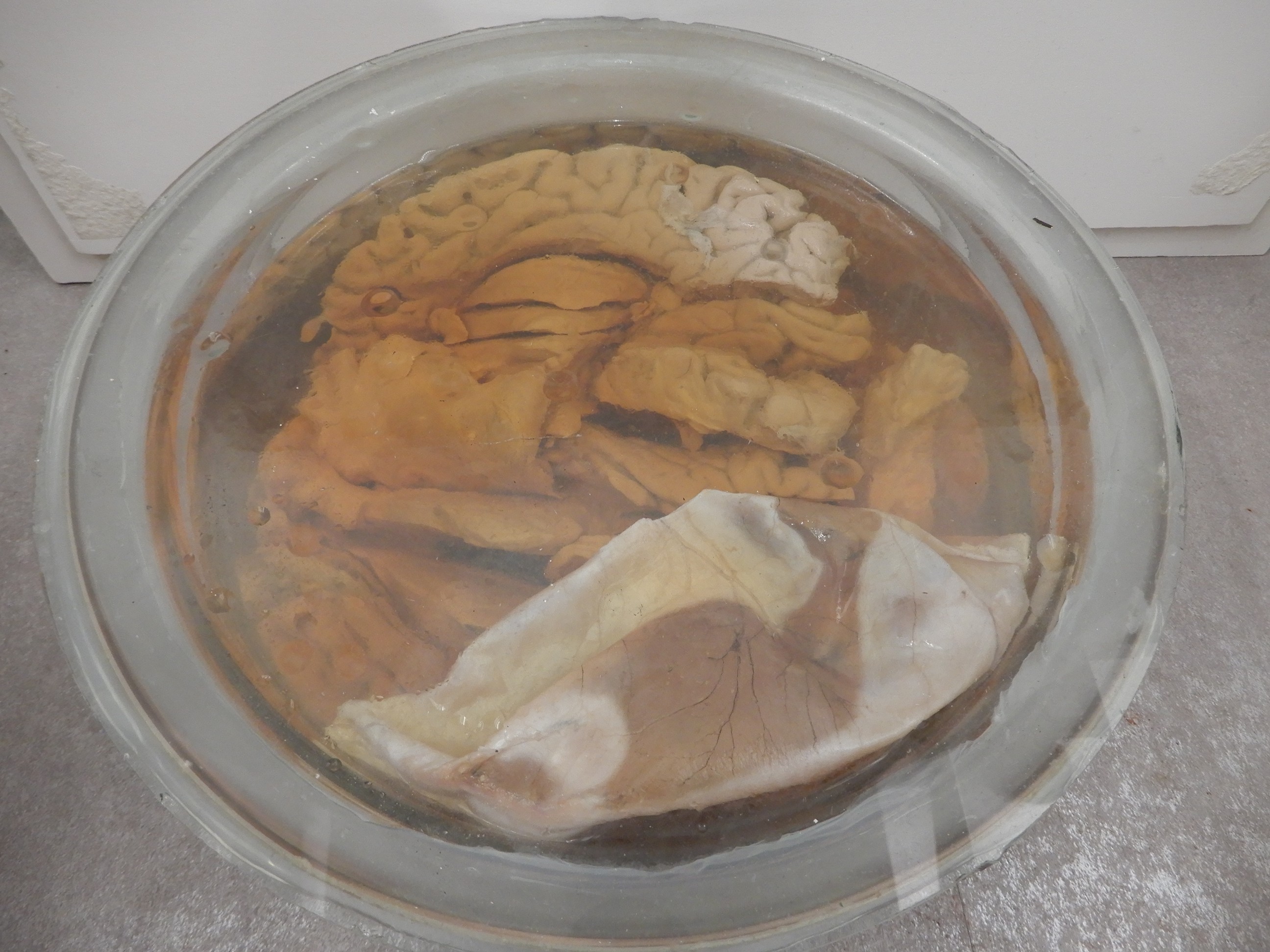 singolo reperto antropologico, preparato anatomico (morfologia alterata per patologia) (XIX-XX)