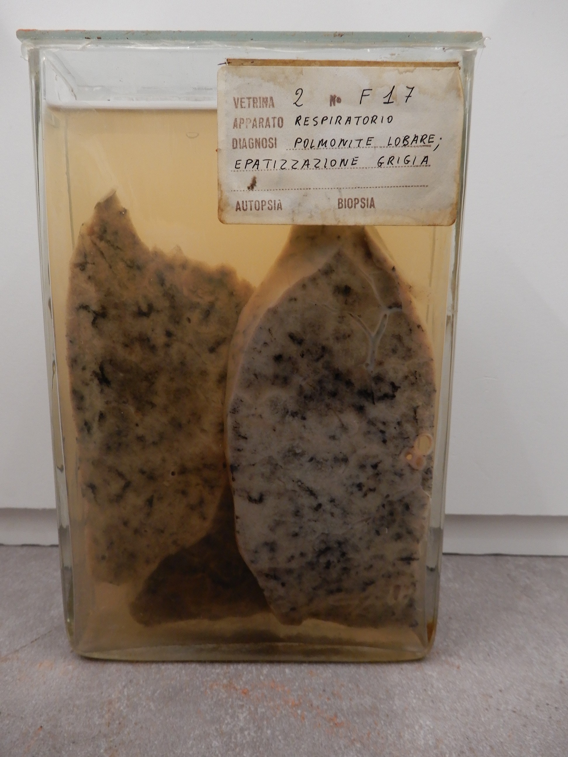 singolo reperto antropologico, preparato anatomico (morfologia alterata per patologia) (XIX-XX)