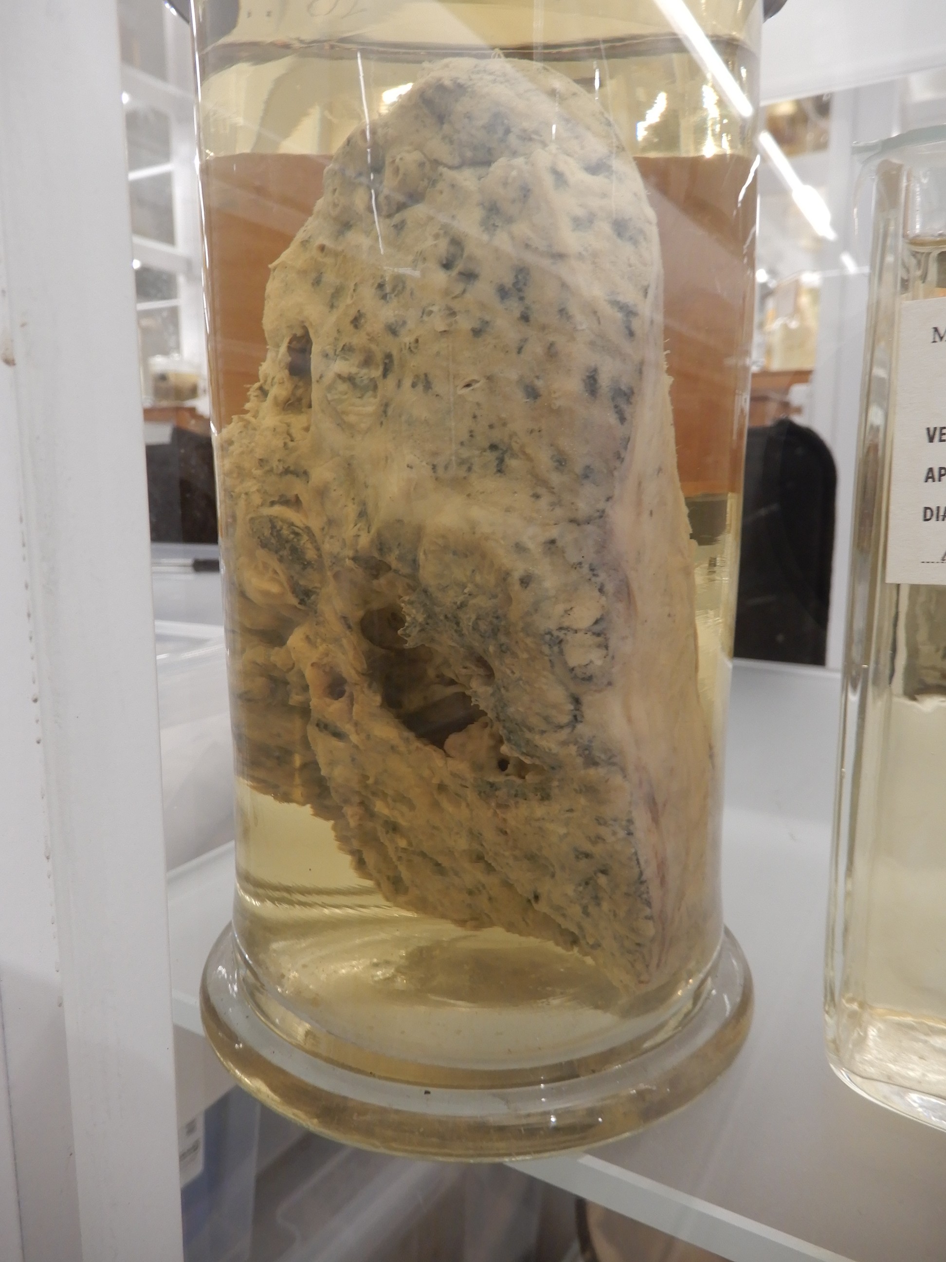 singolo reperto antropologico, preparato anatomico (morfologia alterata per patologia) (XIX-XX)