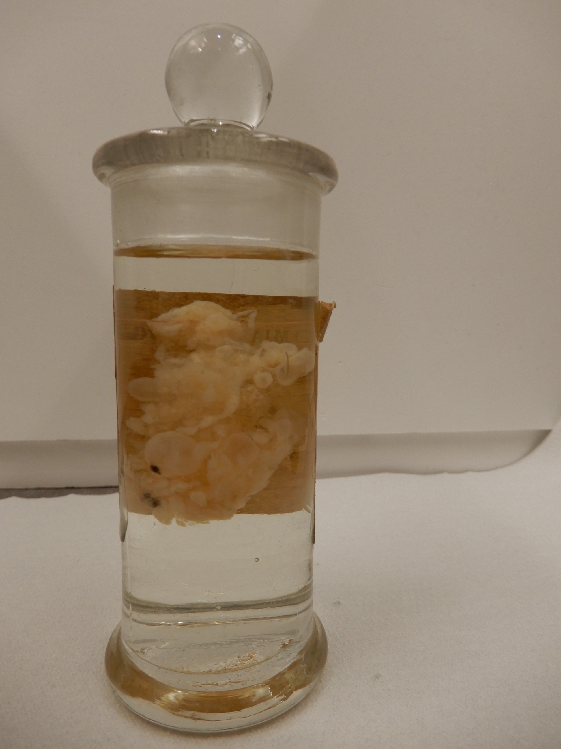 singolo reperto antropologico, preparato anatomico (morfologia alterata per patologia) (XIX-XX)