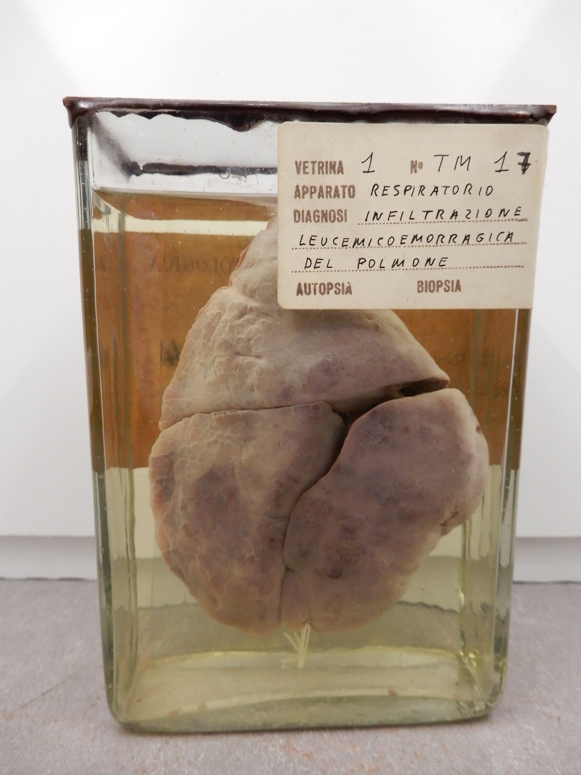 singolo reperto antropologico, preparato anatomico (morfologia alterata per patologia) (XIX-XX)