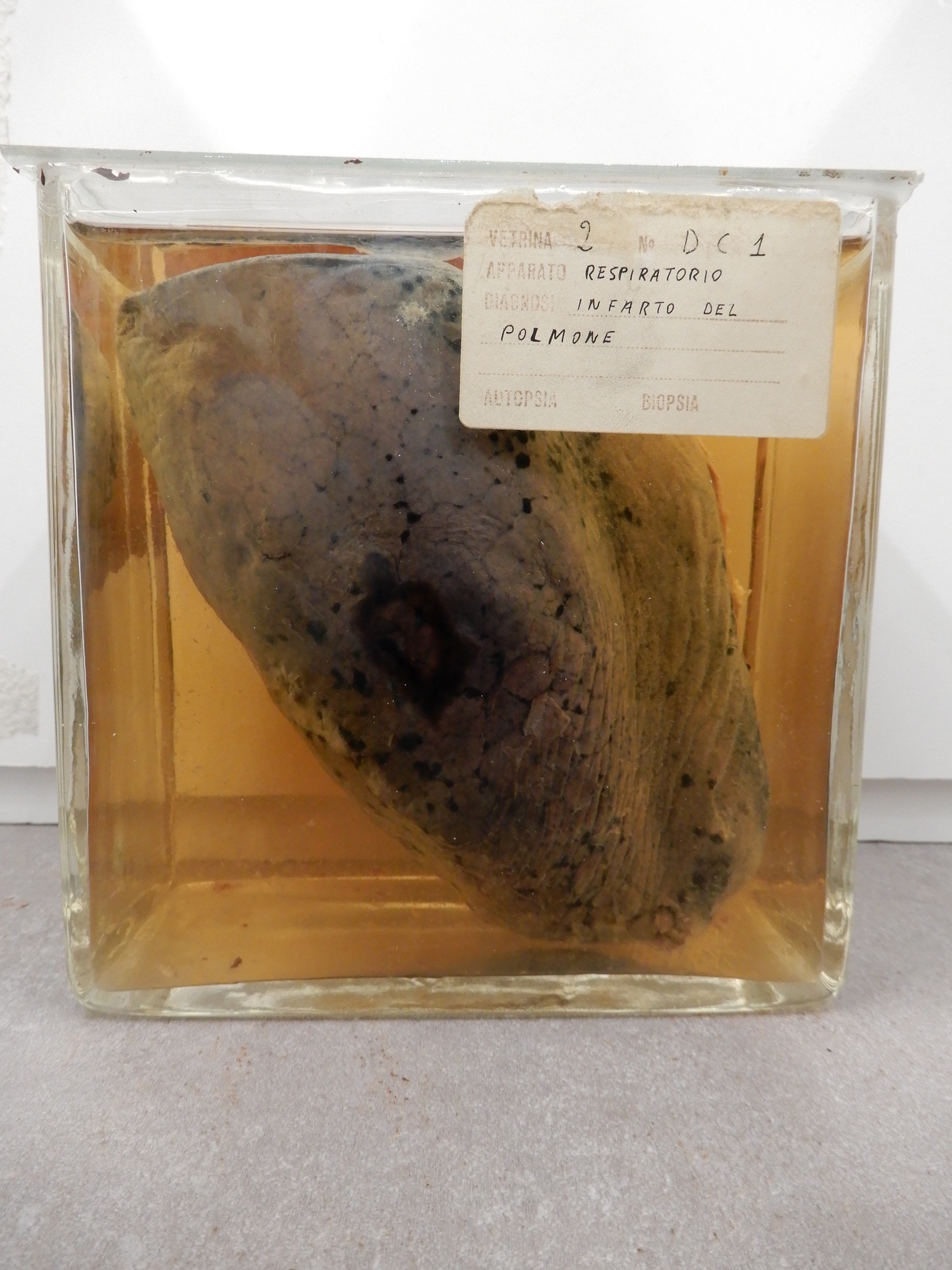 singolo reperto antropologico, preparato anatomico (morfologia alterata per patologia) (XIX-XX)