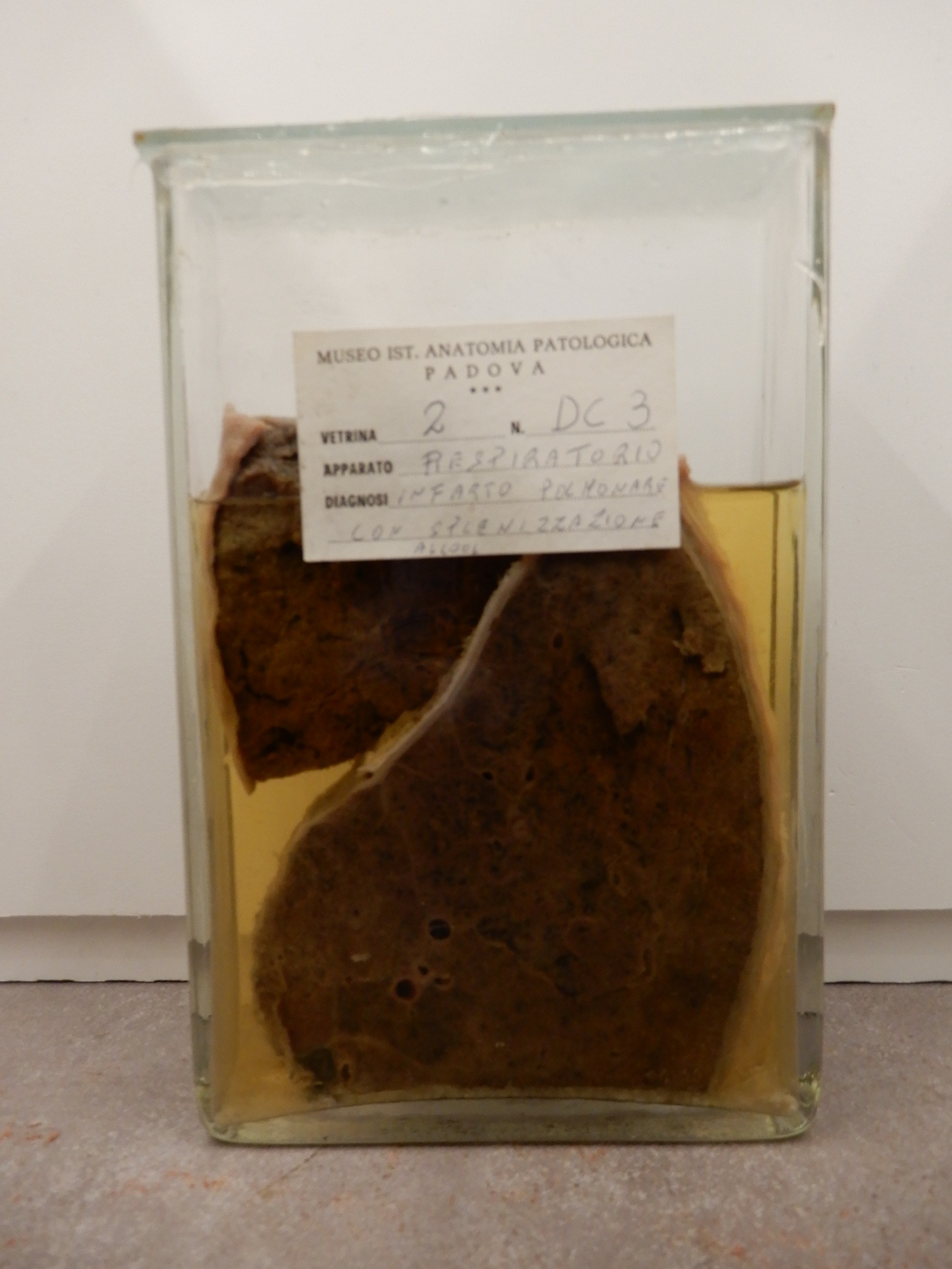 singolo reperto antropologico, preparato anatomico (morfologia alterata per patologia) (XIX-XX)