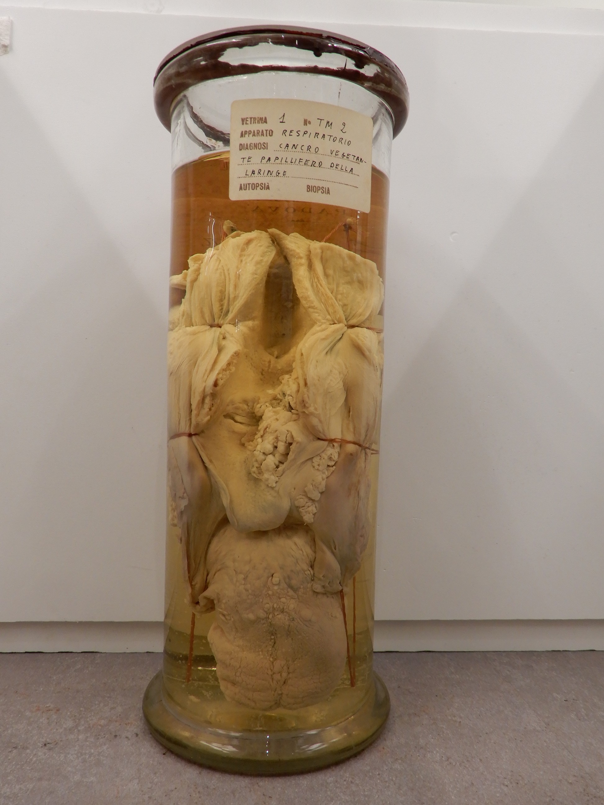 singolo reperto antropologico, preparato anatomico (morfologia alterata per patologia) (XIX-XX)