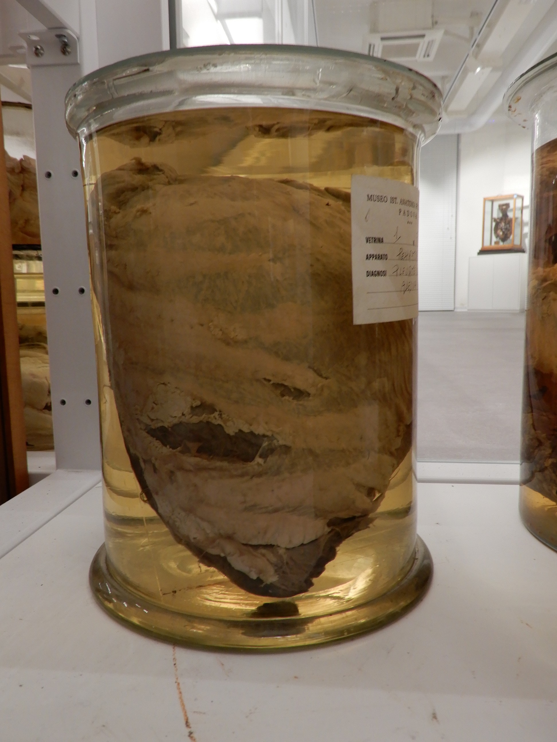 singolo reperto antropologico, preparato anatomico (morfologia alterata per patologia) (XIX-XX)